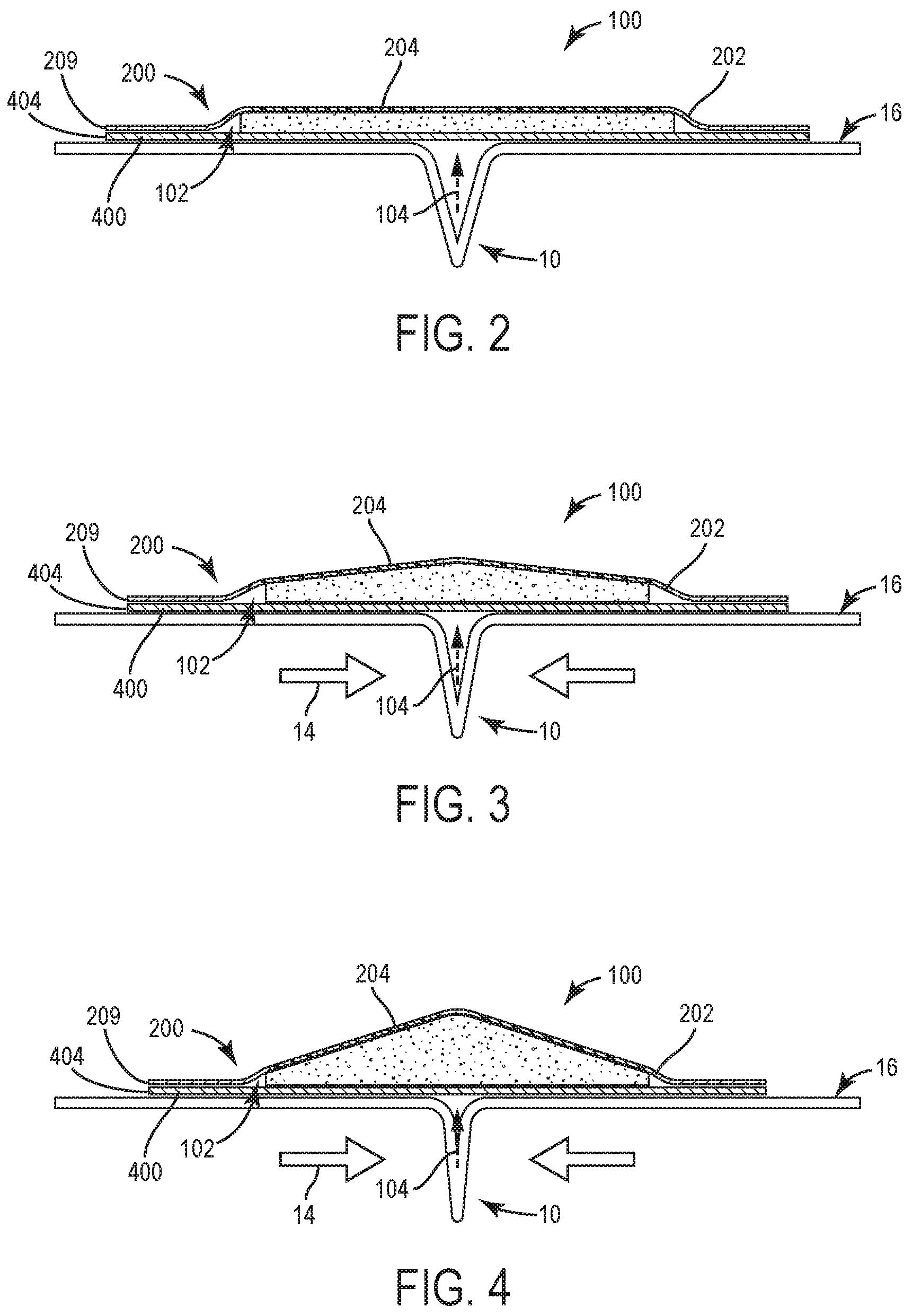 Patent US12350128 Figure 2 – Advanced wound dressing for incisional wounds that provides apposition forces as a result of fluid absorption