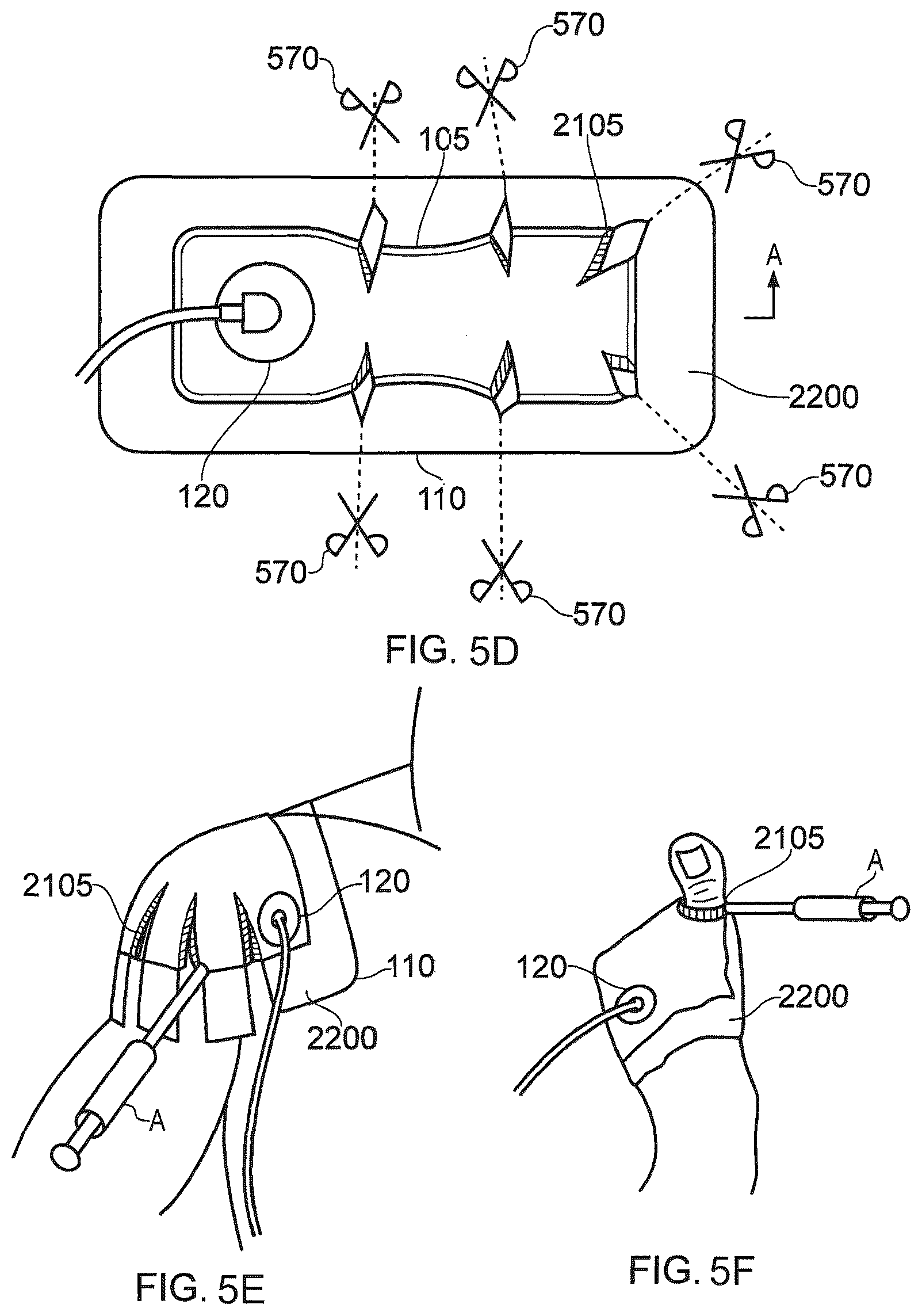 Patent US12350129 Figure 6 – Wound dressing sealant and use thereof