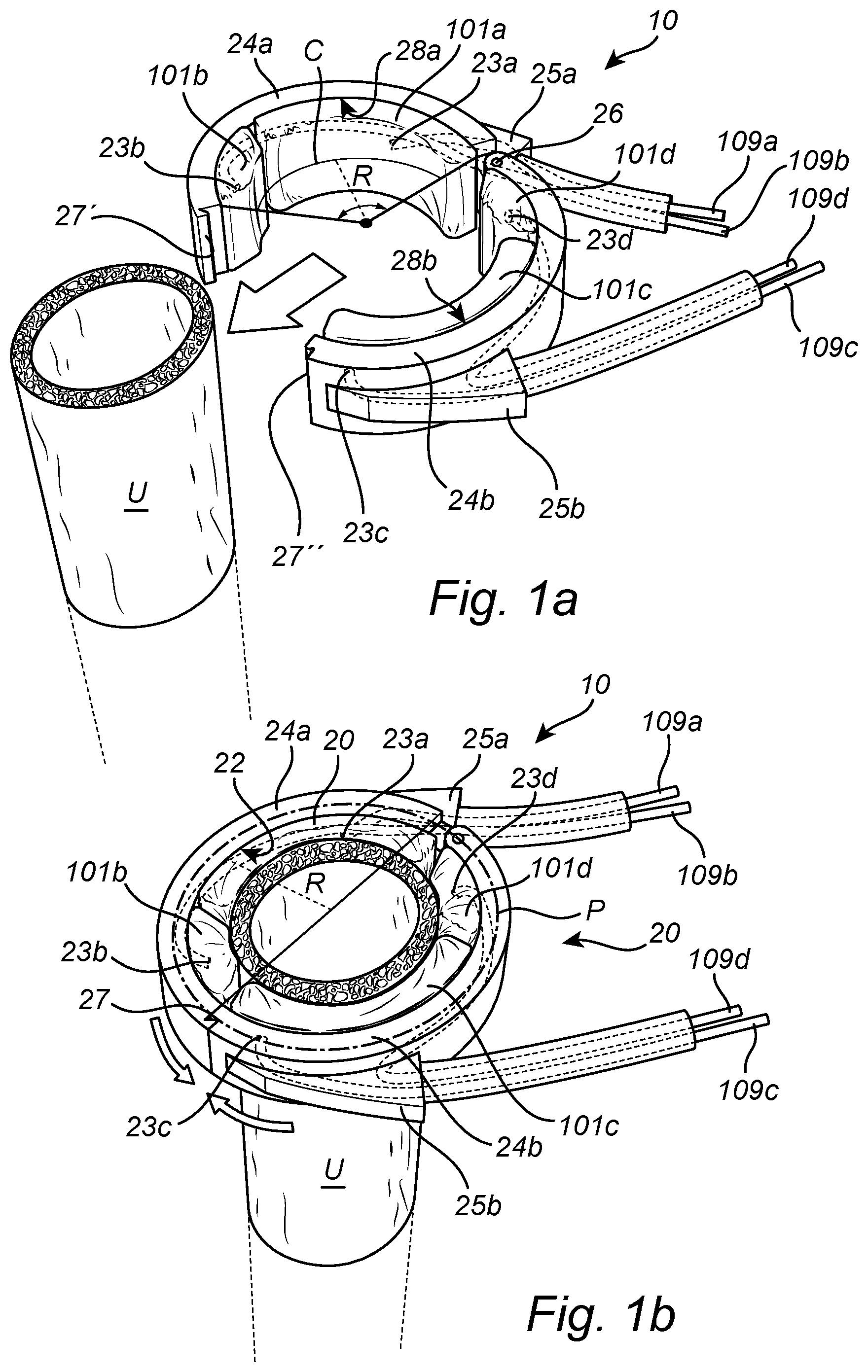 Patent US12350138 Figure 1 – Implantable urethra restriction device