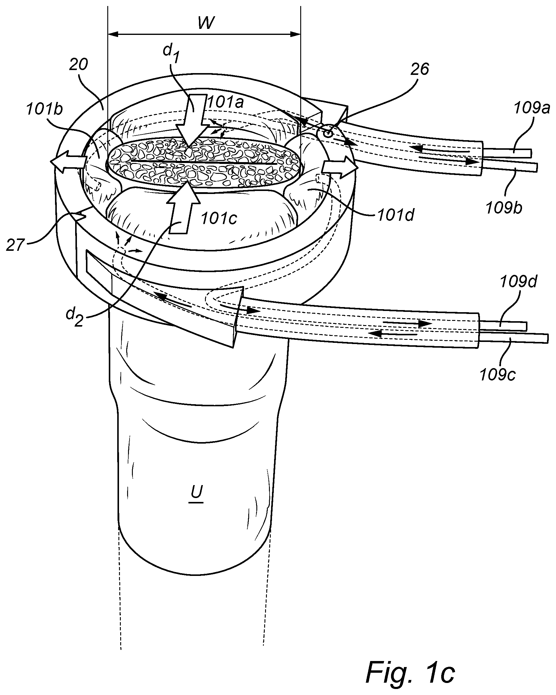 Patent US12350138 Figure 2 – Implantable urethra restriction device