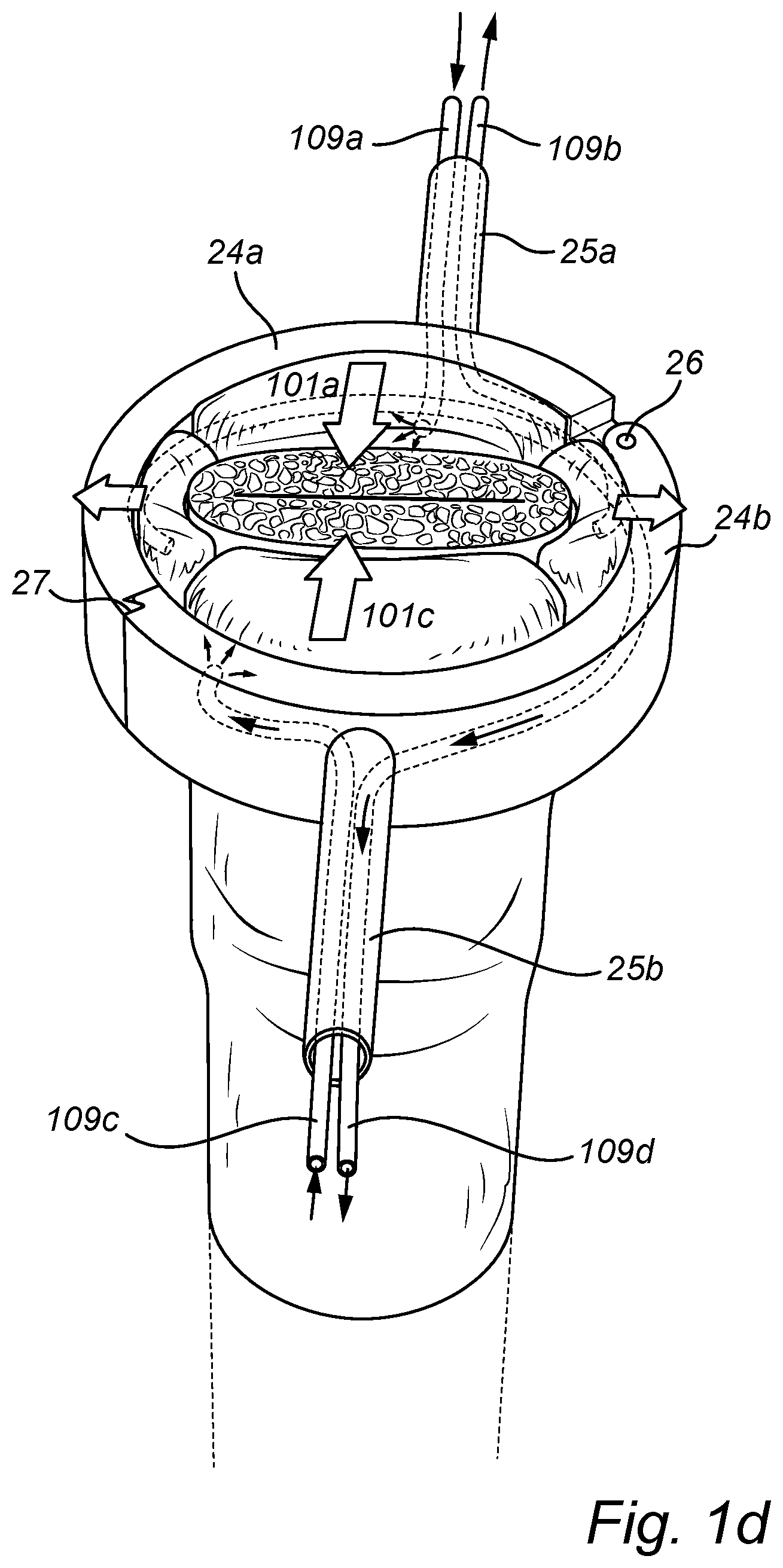 Patent US12350138 Figure 3 – Implantable urethra restriction device