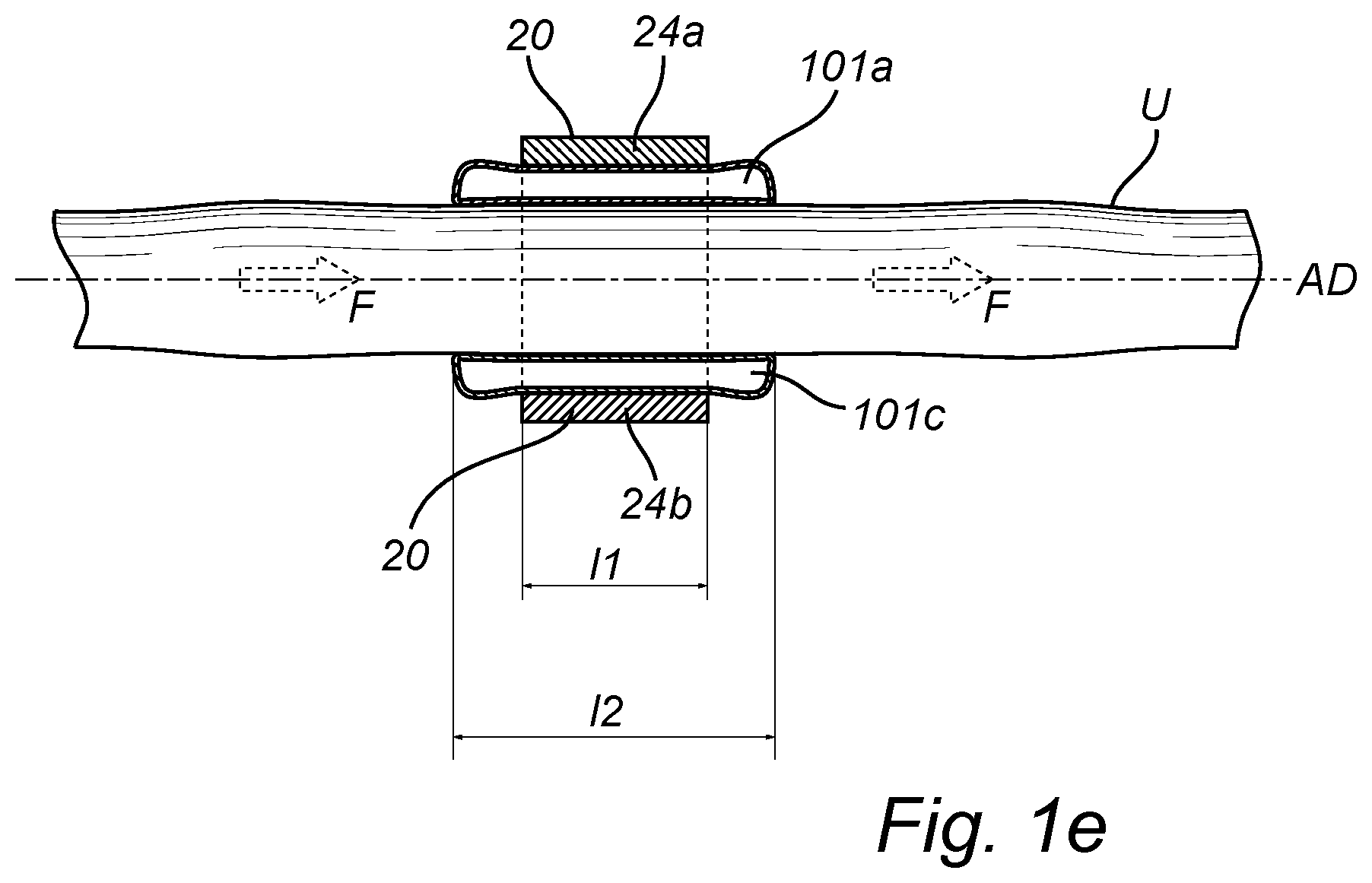 Patent US12350138 Figure 4 – Implantable urethra restriction device