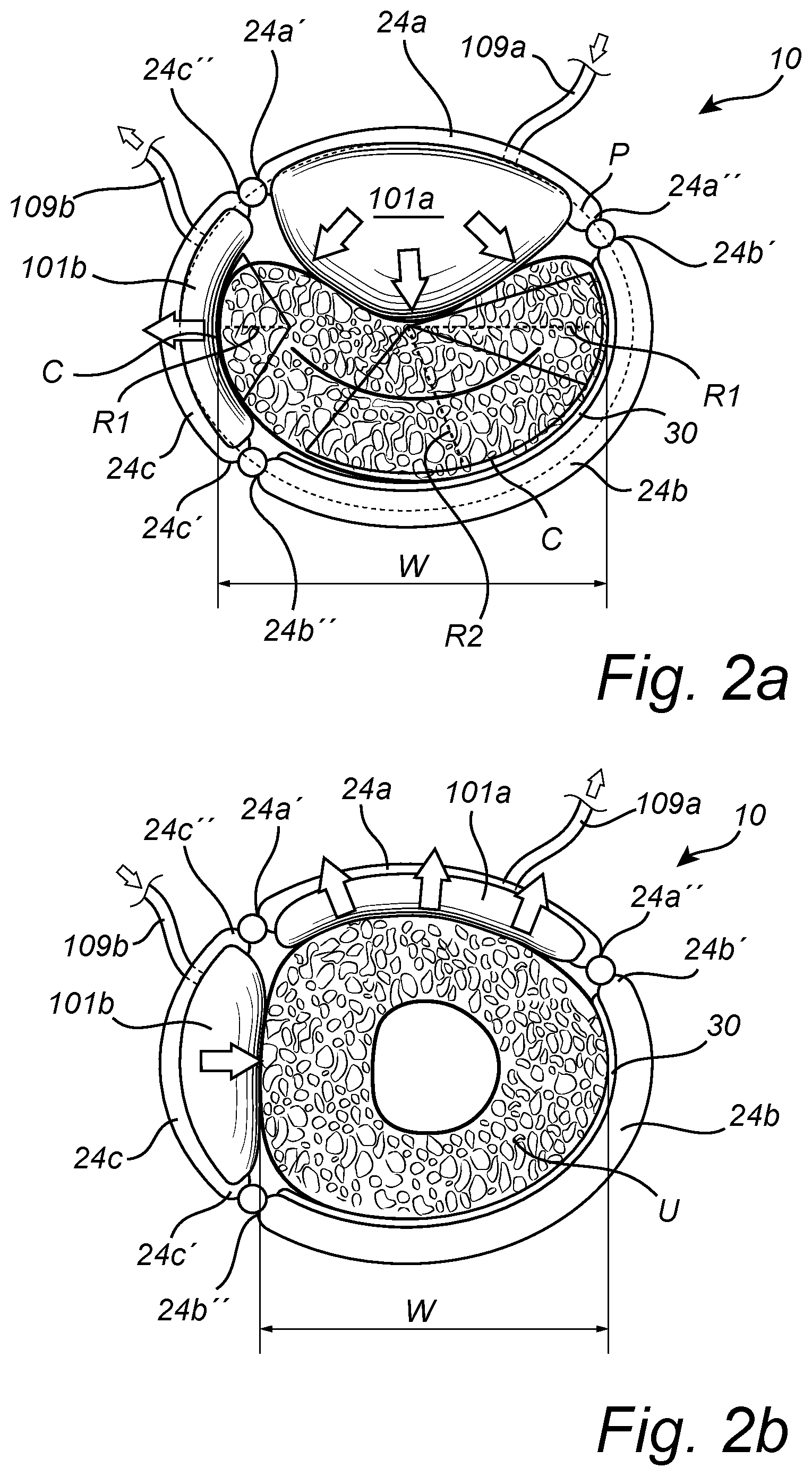 Patent US12350138 Figure 5 – Implantable urethra restriction device