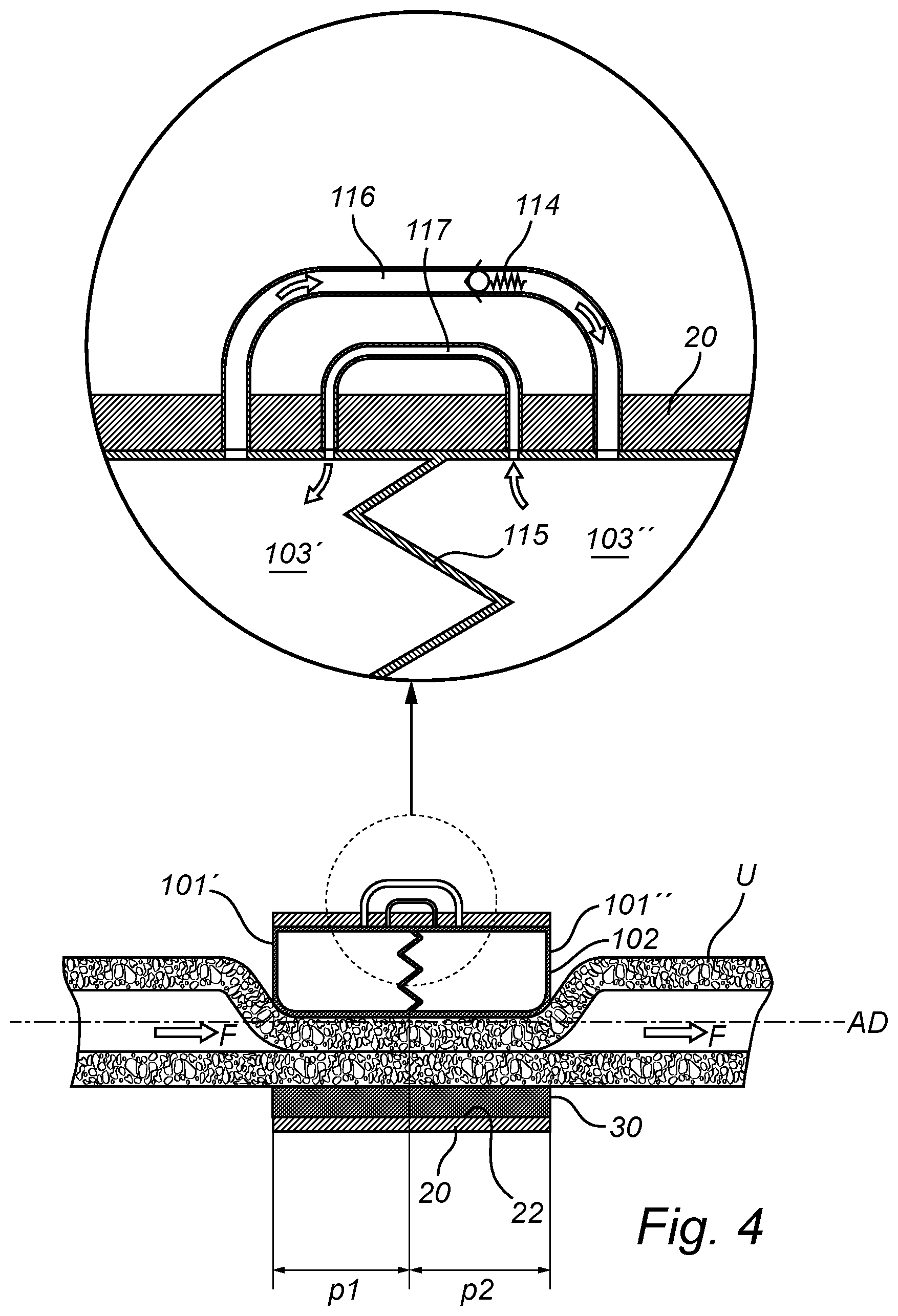Patent US12350138 Figure 8 – Implantable urethra restriction device