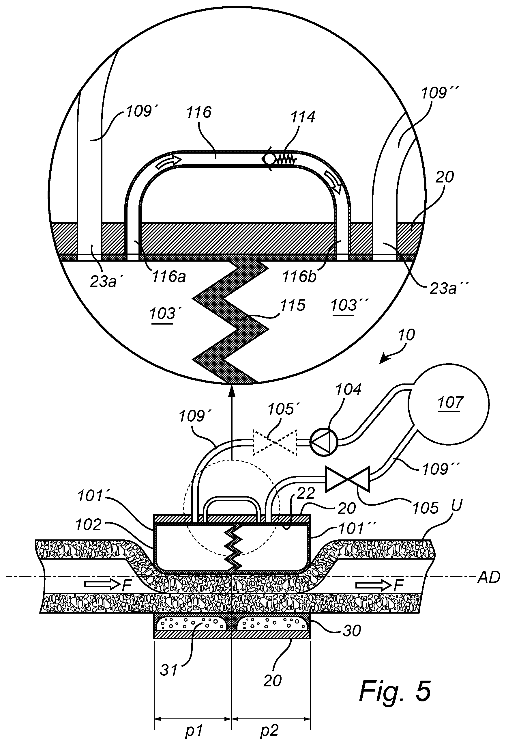 Patent US12350138 Figure 9 – Implantable urethra restriction device