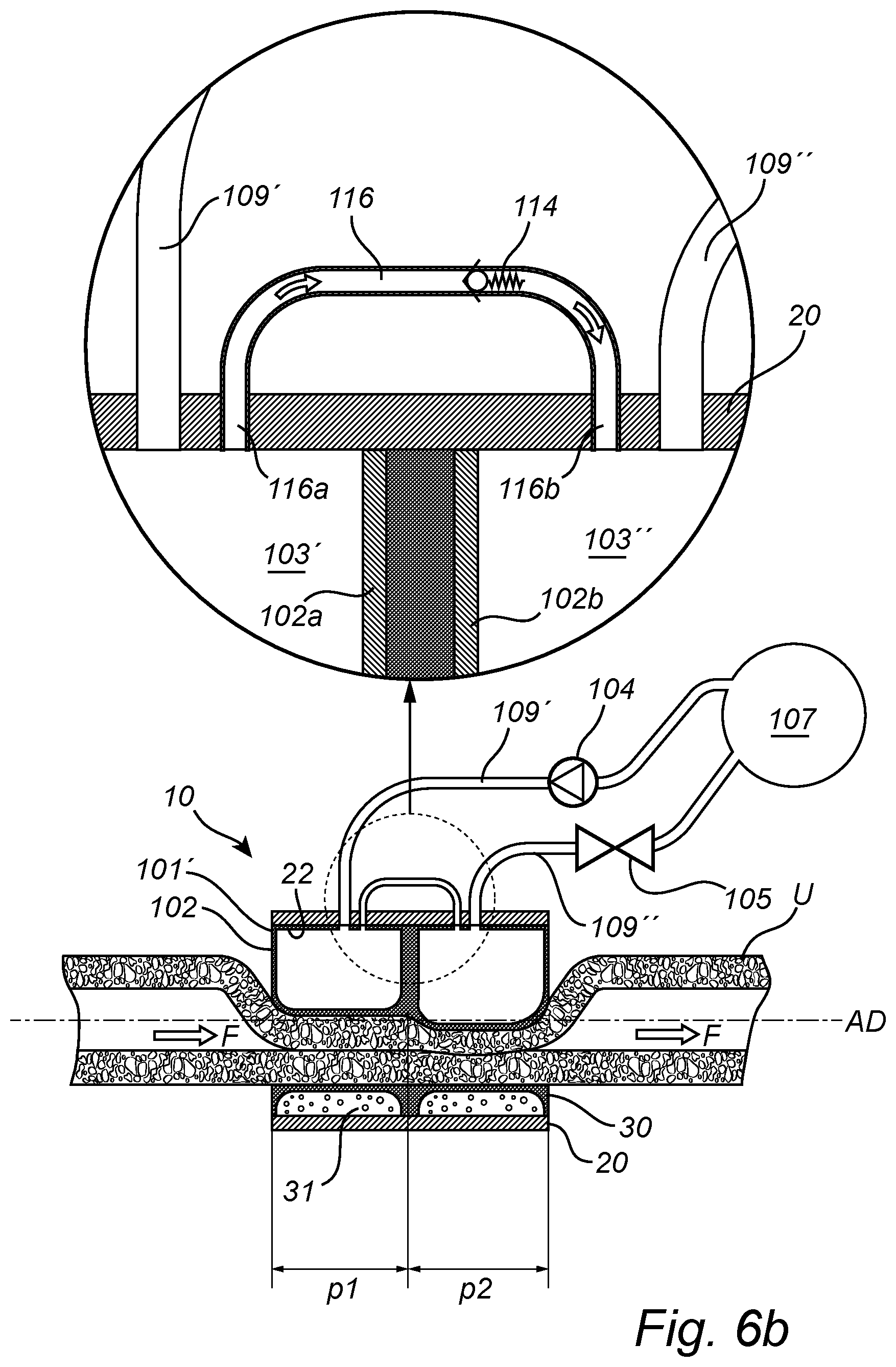 Patent US12350138 Figure 11 – Implantable urethra restriction device