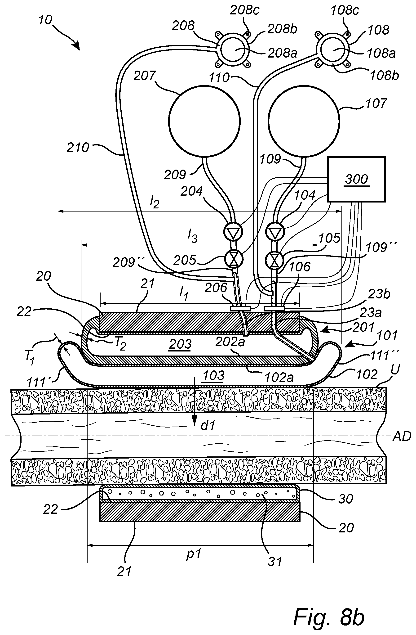 Patent US12350138 Figure 14 – Implantable urethra restriction device