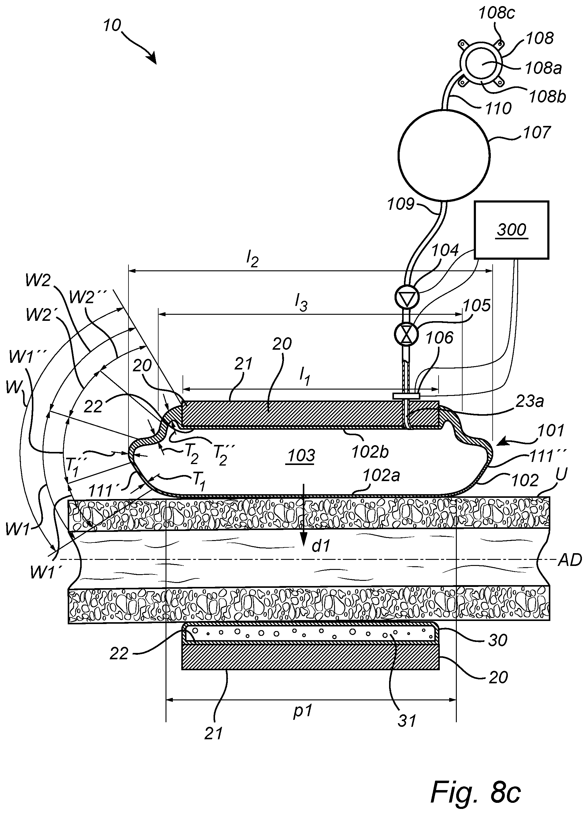 Patent US12350138 Figure 15 – Implantable urethra restriction device