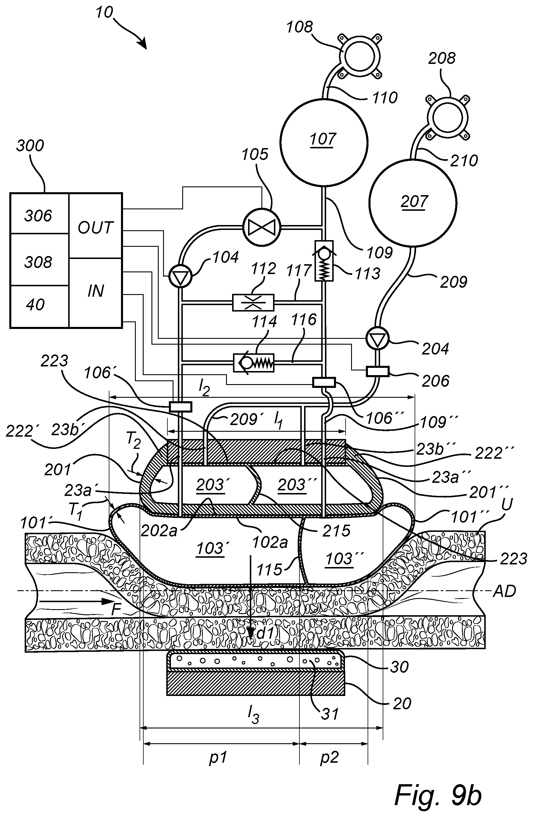 Patent US12350138 Figure 17 – Implantable urethra restriction device
