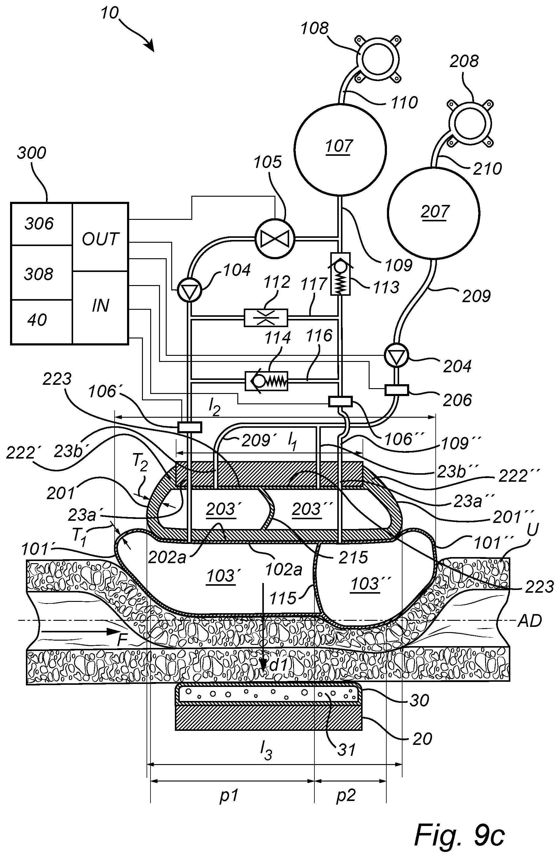 Patent US12350138 Figure 18 – Implantable urethra restriction device