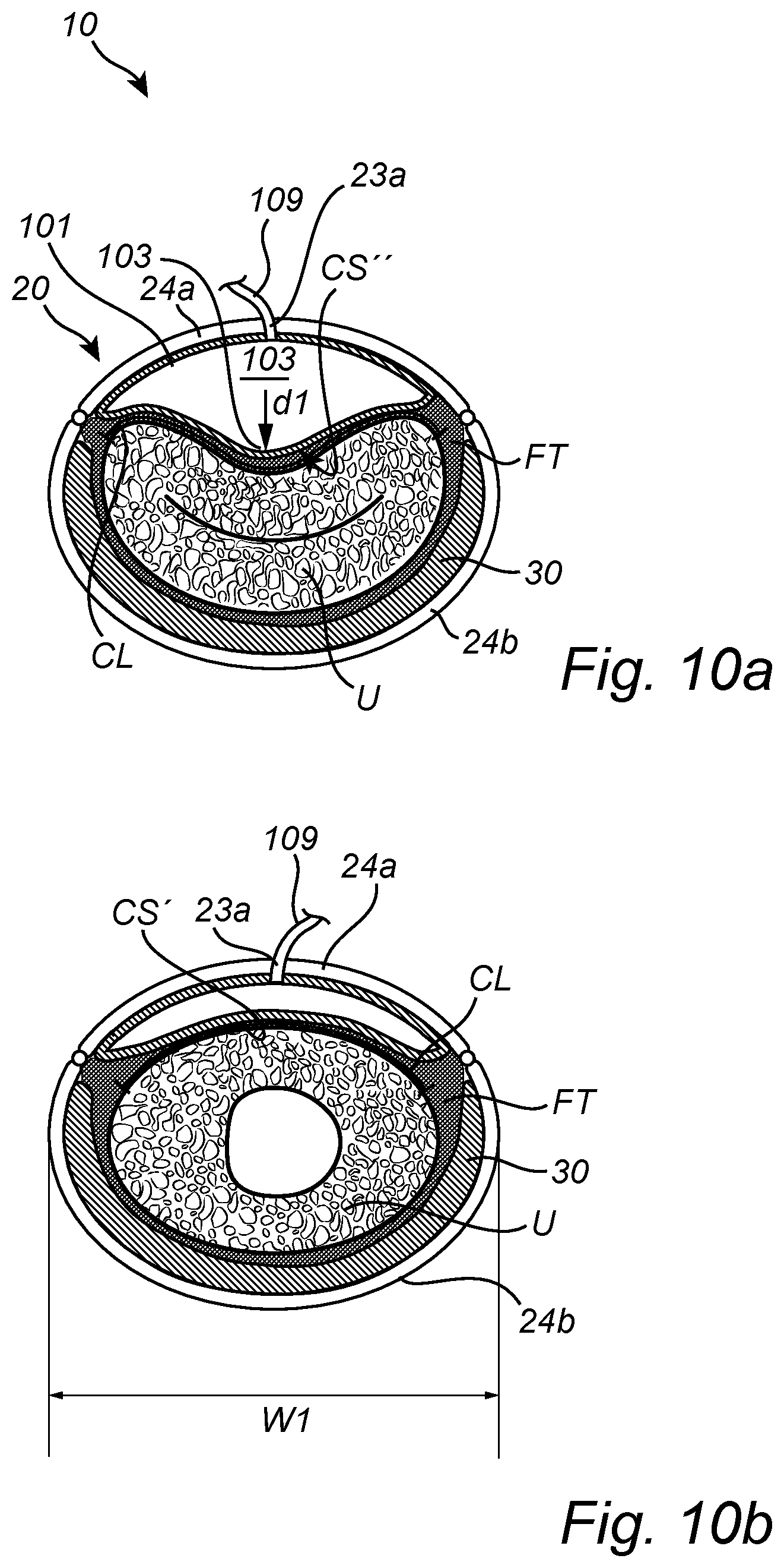 Patent US12350138 Figure 19 – Implantable urethra restriction device
