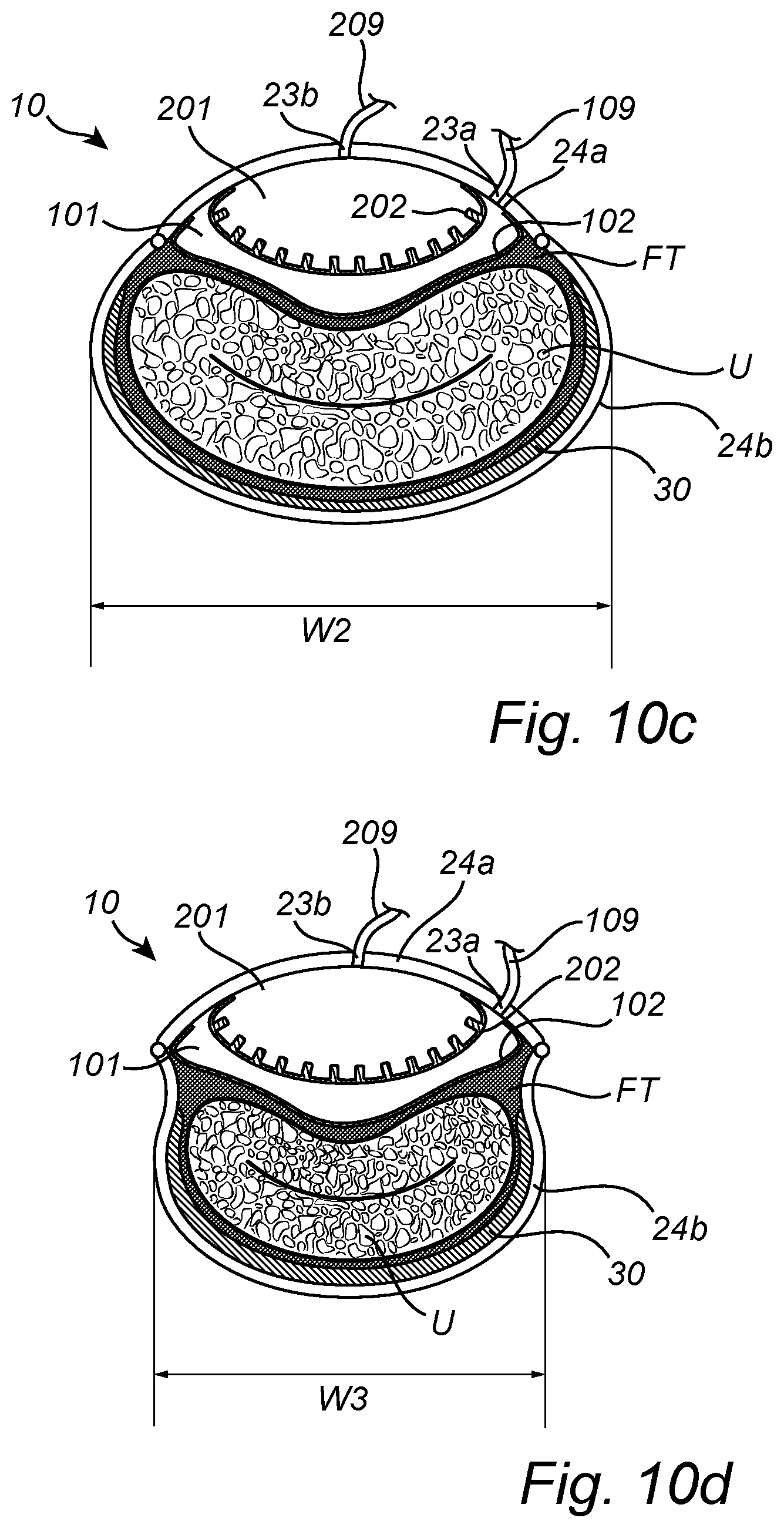 Patent US12350138 Figure 20 – Implantable urethra restriction device