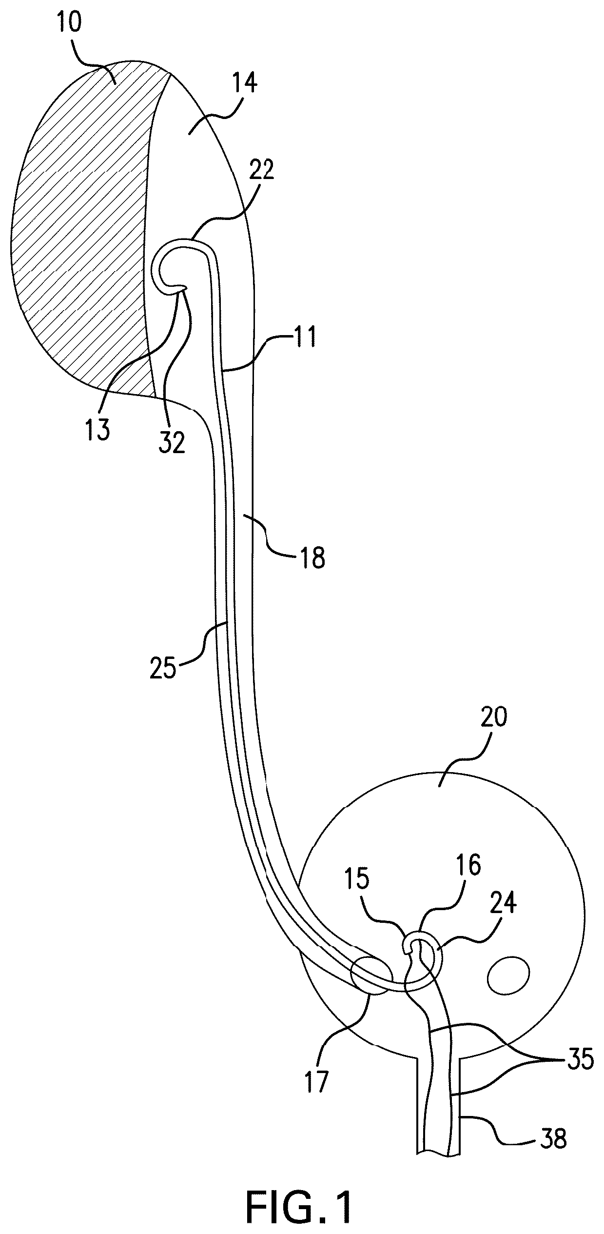 Patent US12350140 — Variable length stent — Figure 1