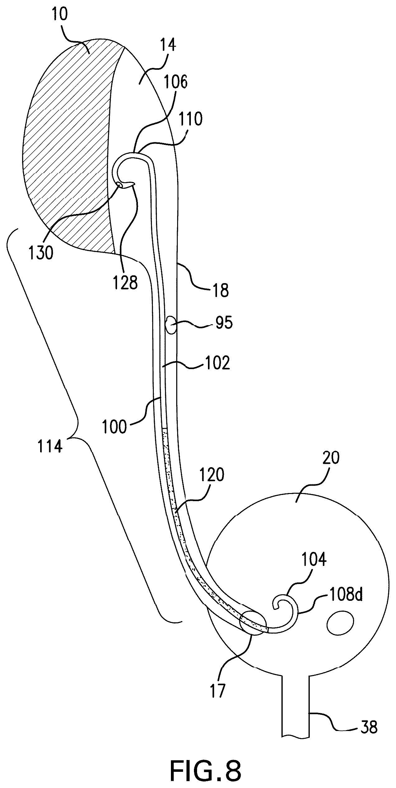 Patent US12350140 Figure 9 – Variable length stent