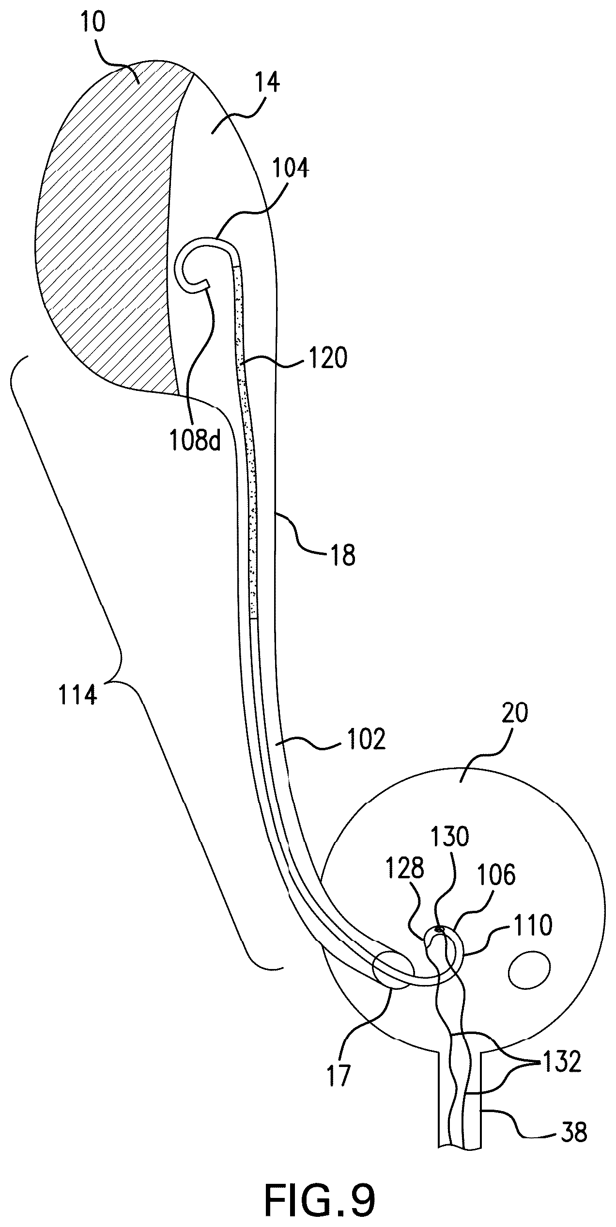 Patent US12350140 Figure 10 – Variable length stent