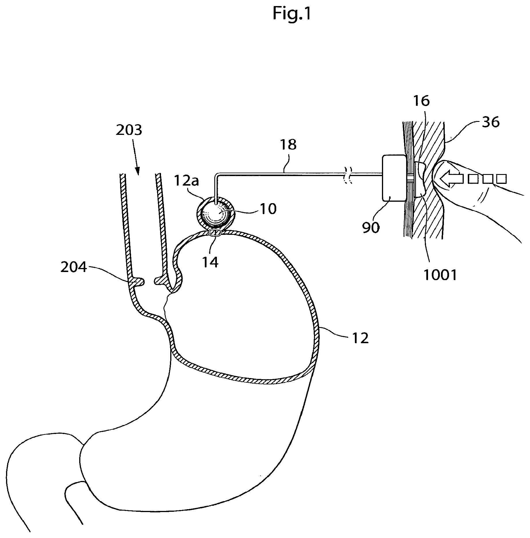 Patent US12350141 Figure 1 – Method and instrument for treating obesity