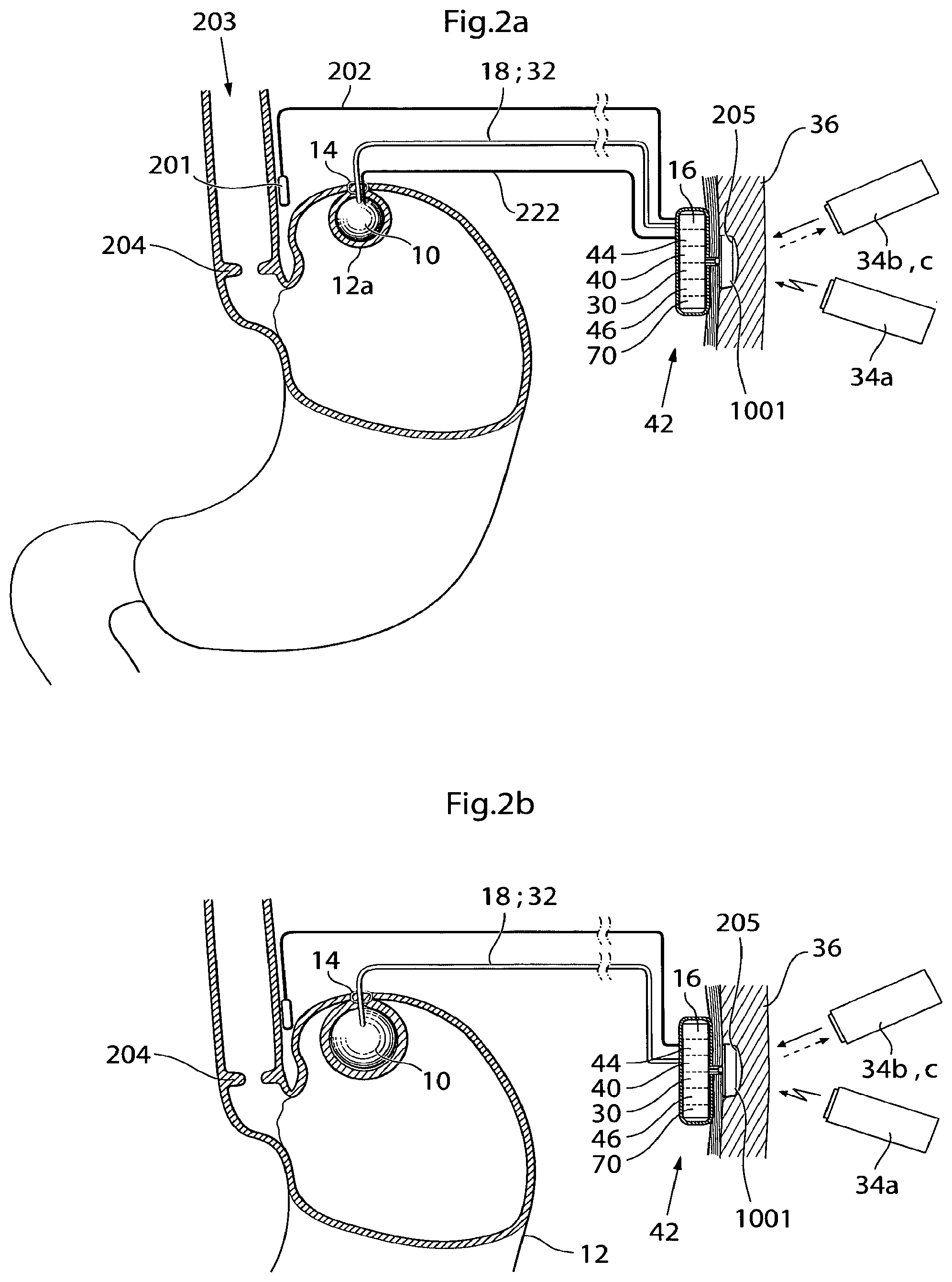 Patent US12350141 Figure 2 – Method and instrument for treating obesity