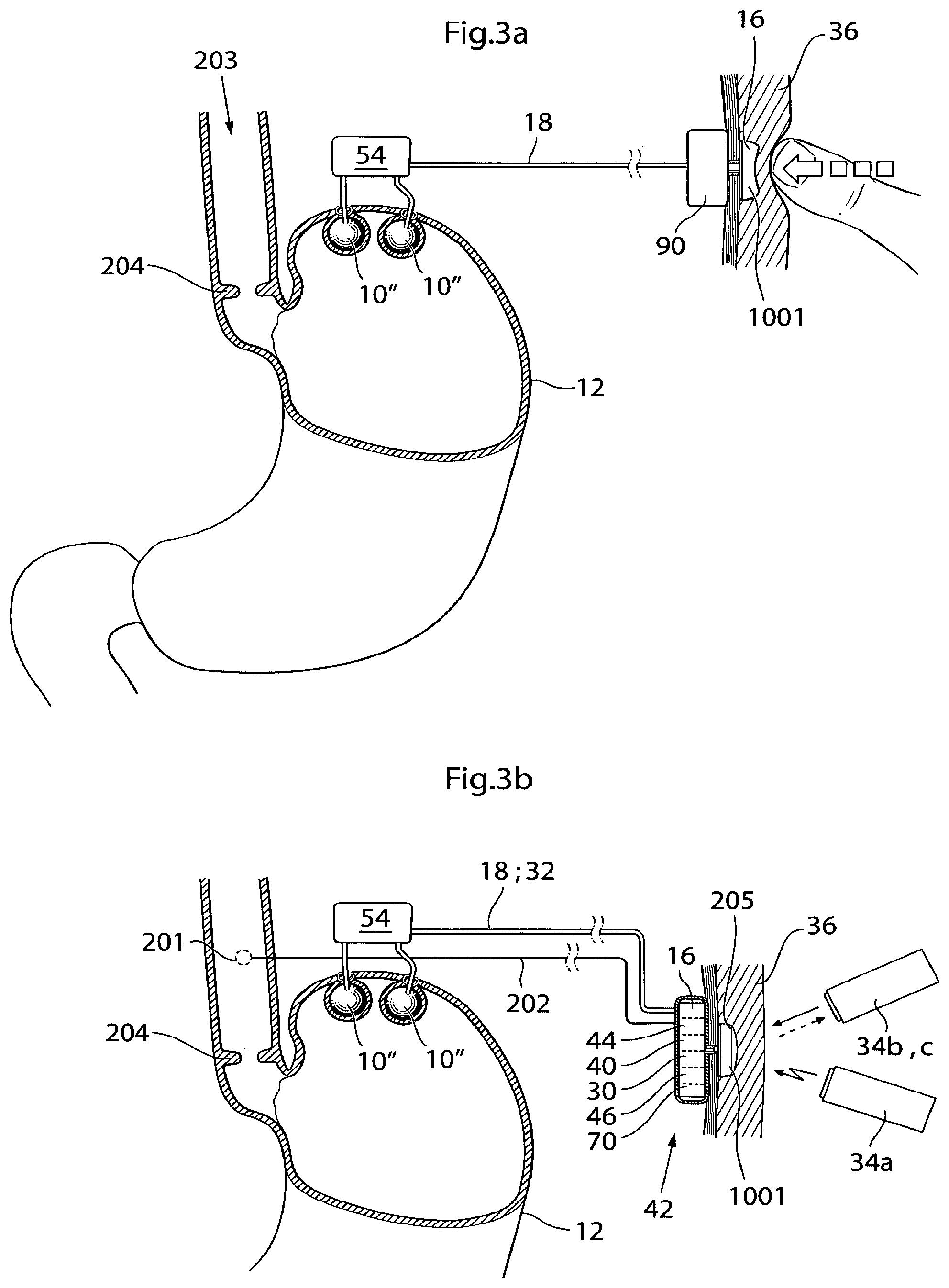 Patent US12350141 Figure 3 – Method and instrument for treating obesity