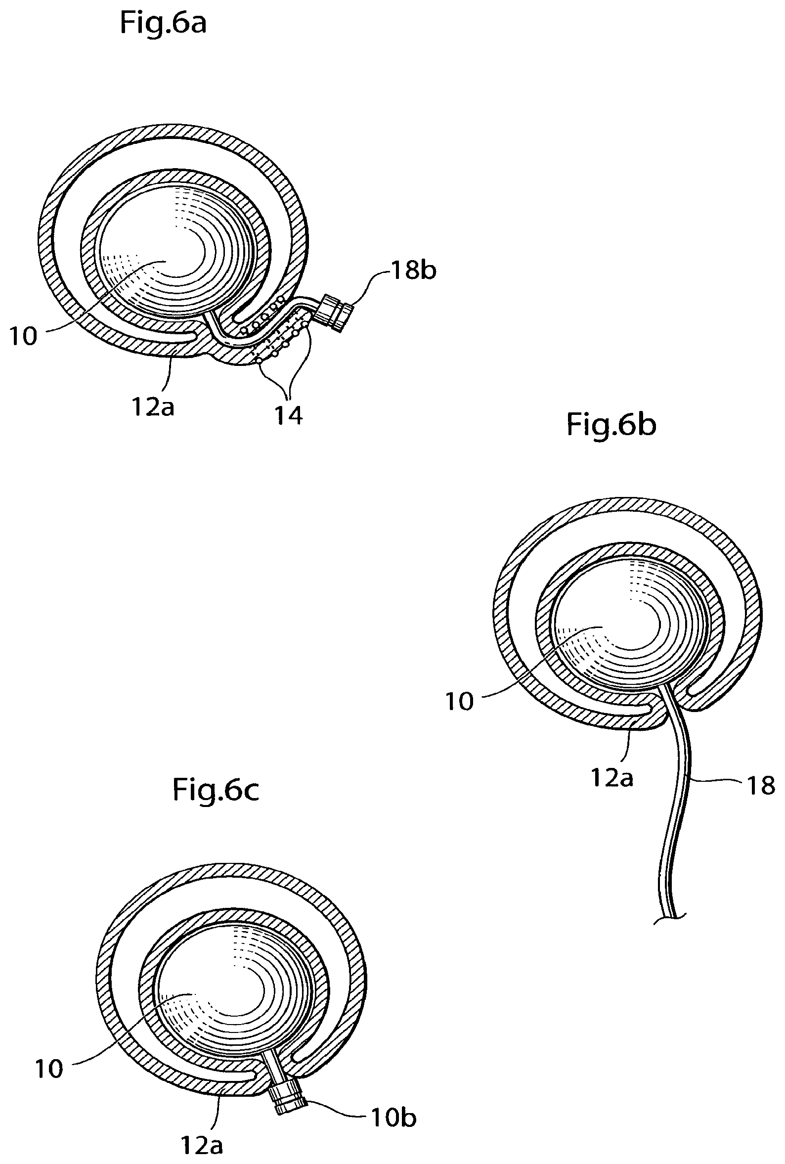 Patent US12350141 Figure 9 – Method and instrument for treating obesity