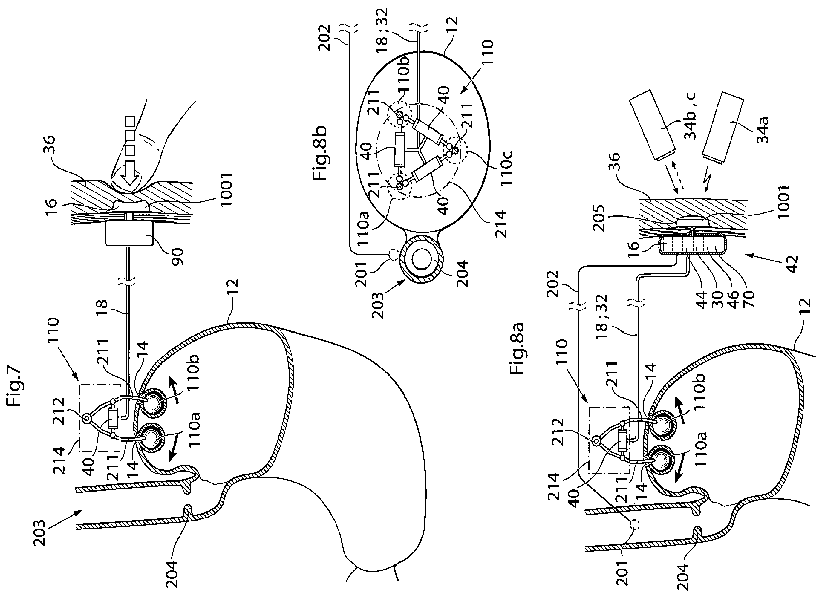 Patent US12350141 Figure 10 – Method and instrument for treating obesity