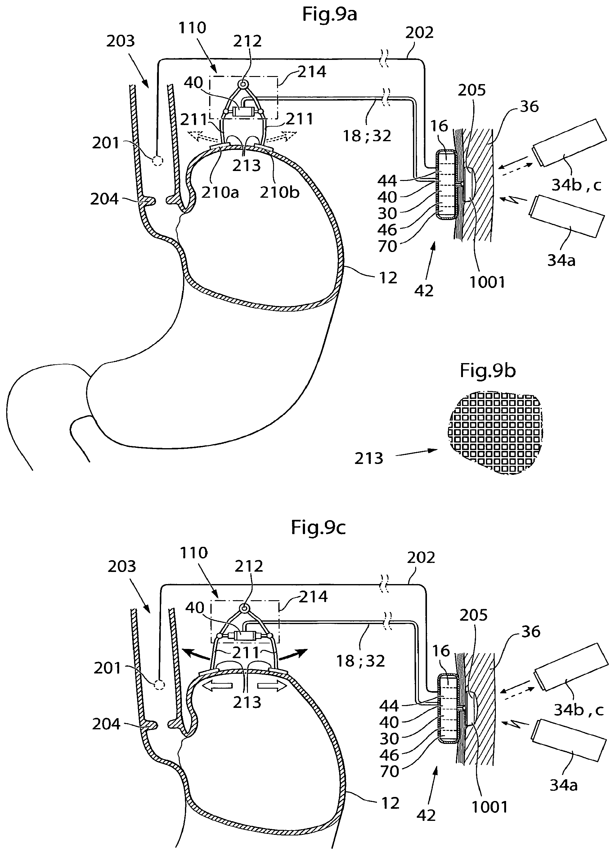 Patent US12350141 Figure 11 – Method and instrument for treating obesity