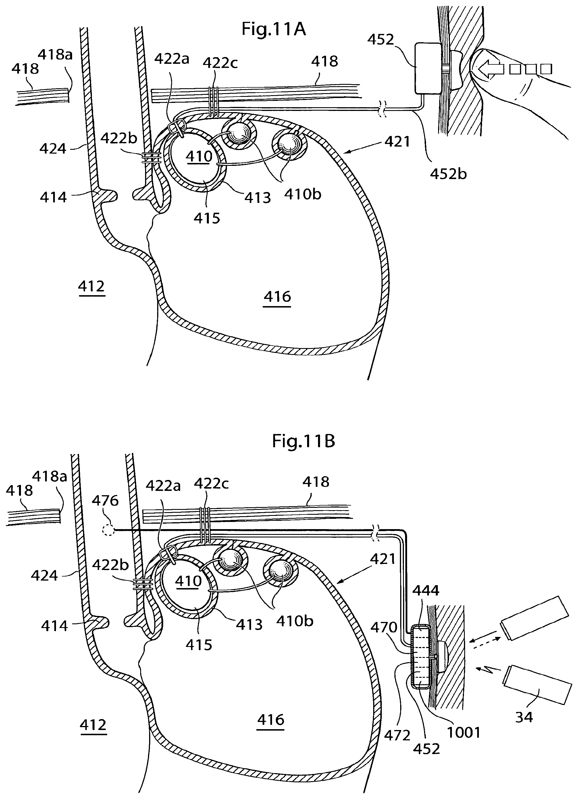 Patent US12350141 Figure 13 – Method and instrument for treating obesity