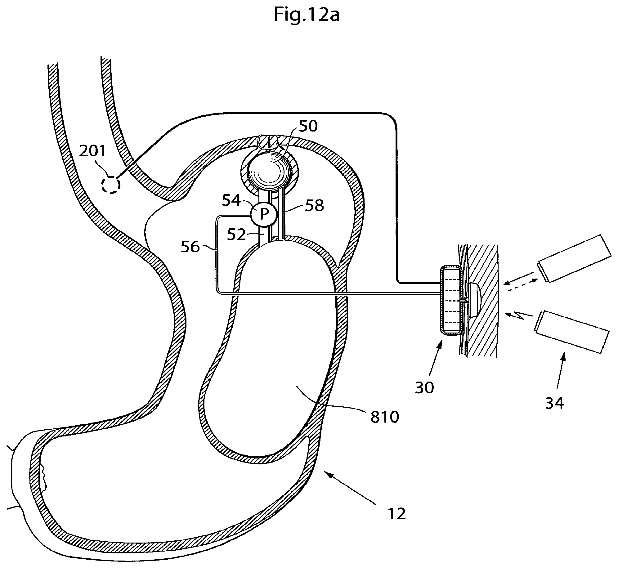 Patent US12350141 Figure 14 – Method and instrument for treating obesity
