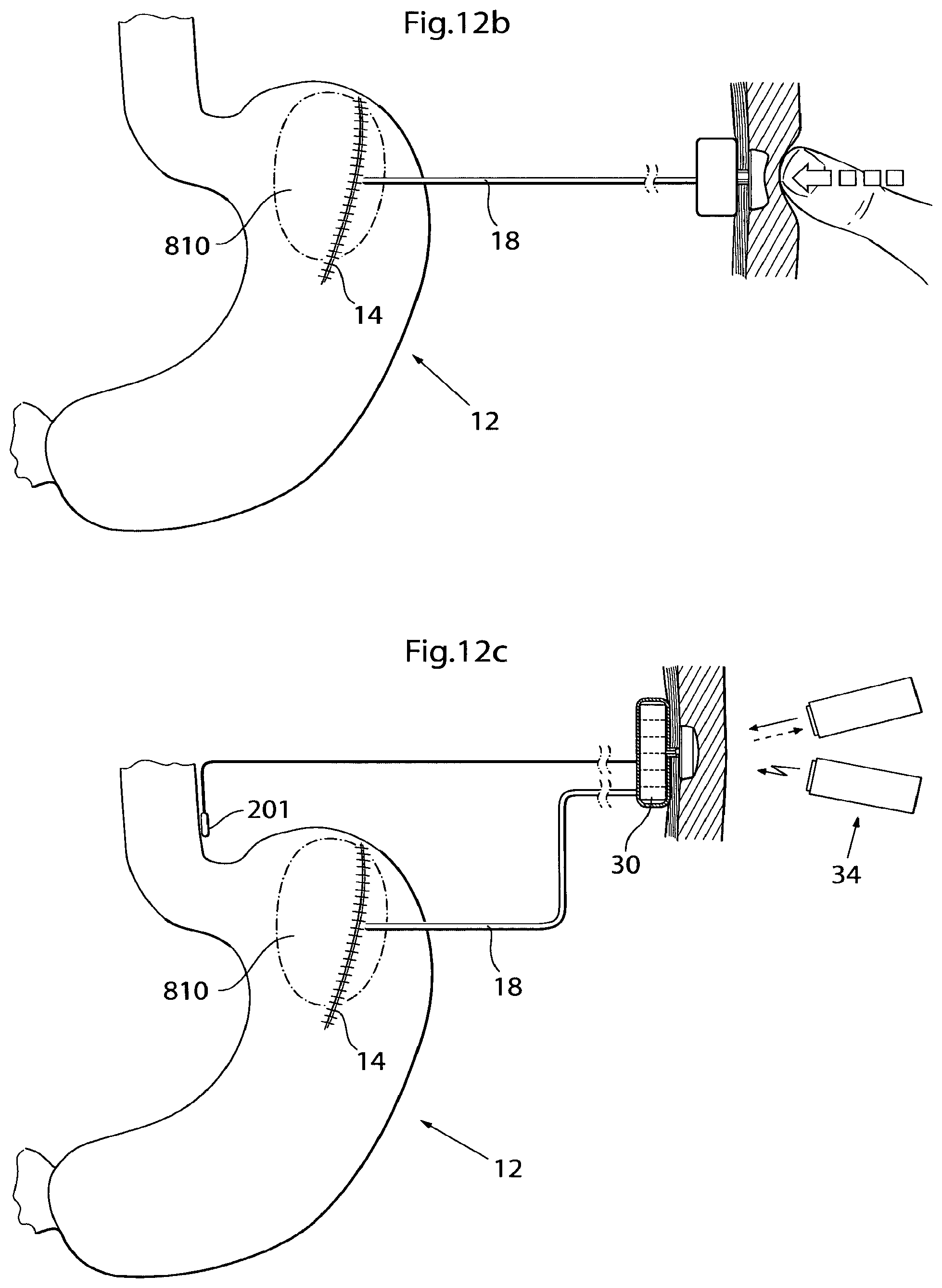 Patent US12350141 Figure 15 – Method and instrument for treating obesity