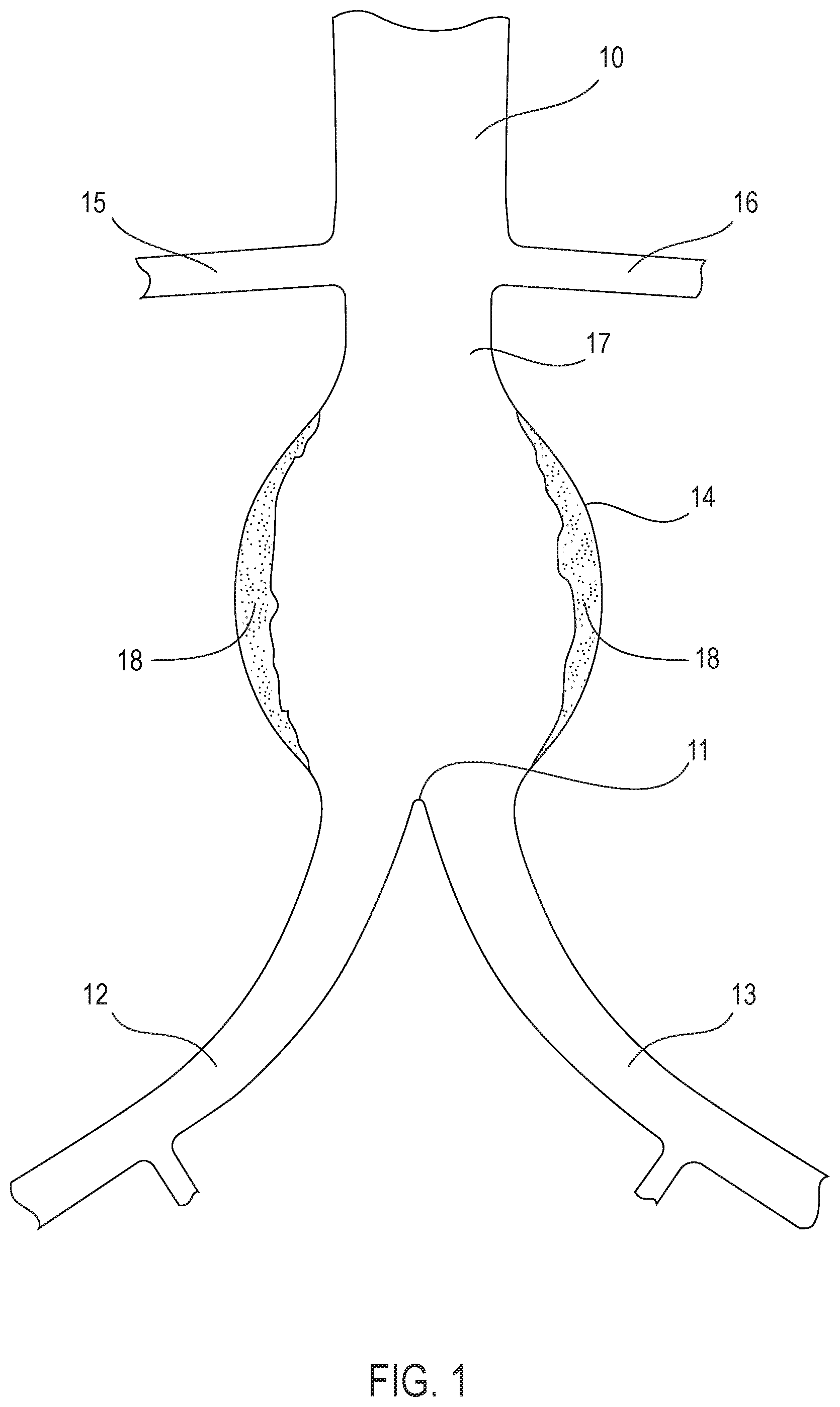 Patent US12350142 Figure 1 – Systems and methods with graft body, inflatable fill channel, and filling structure