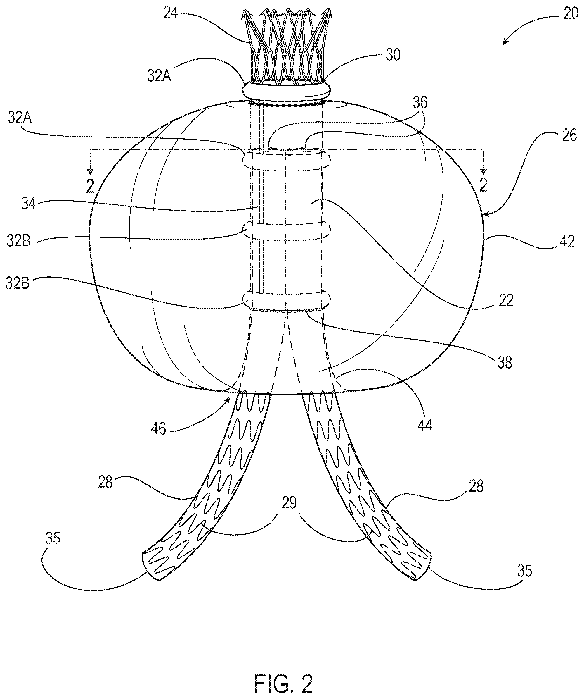 Patent US12350142 Figure 2 – Systems and methods with graft body, inflatable fill channel, and filling structure