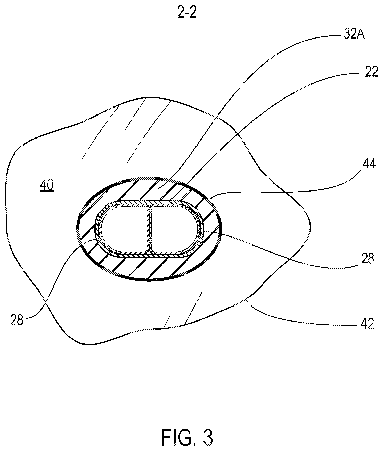 Patent US12350142 Figure 3 – Systems and methods with graft body, inflatable fill channel, and filling structure