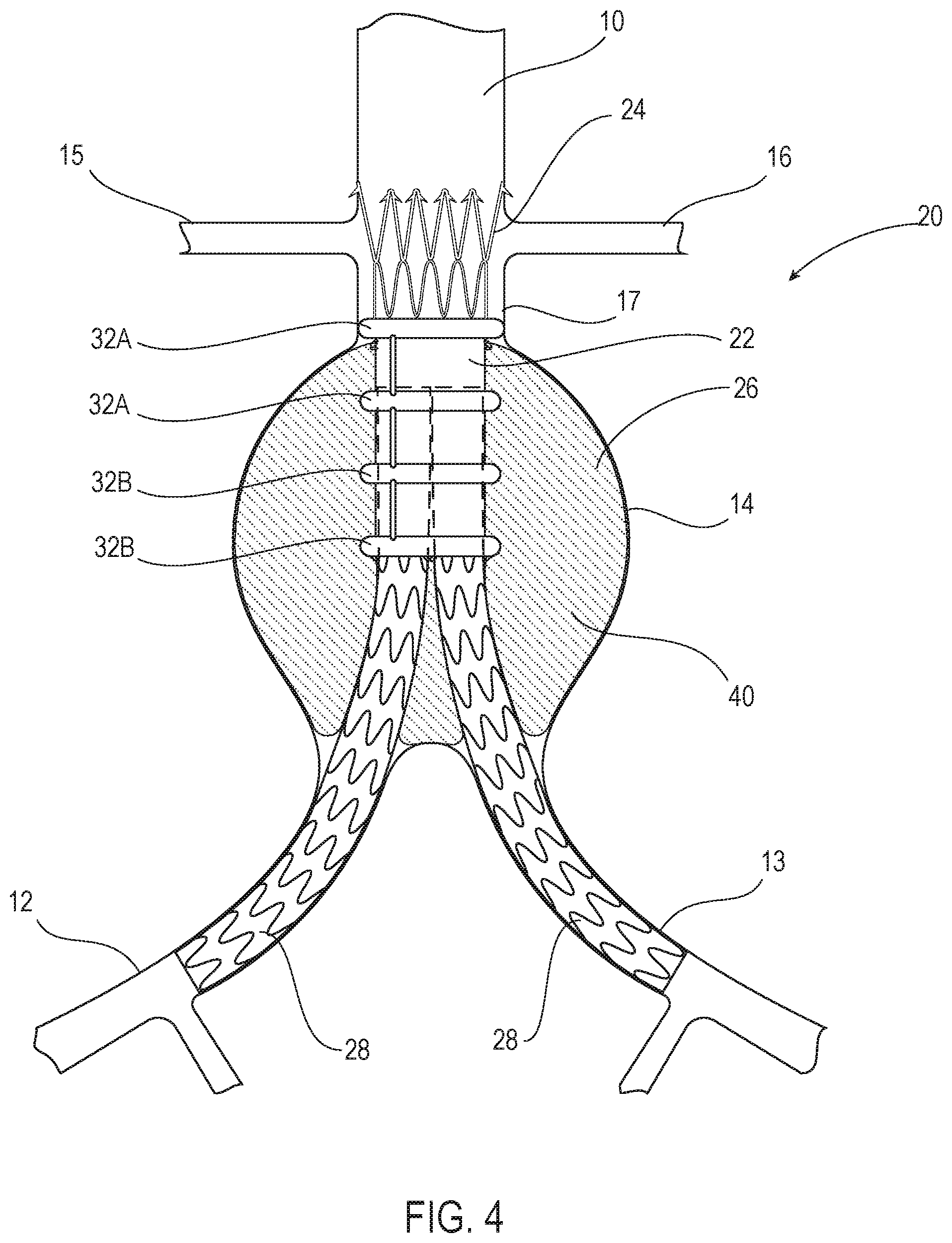 Patent US12350142 Figure 4 – Systems and methods with graft body, inflatable fill channel, and filling structure