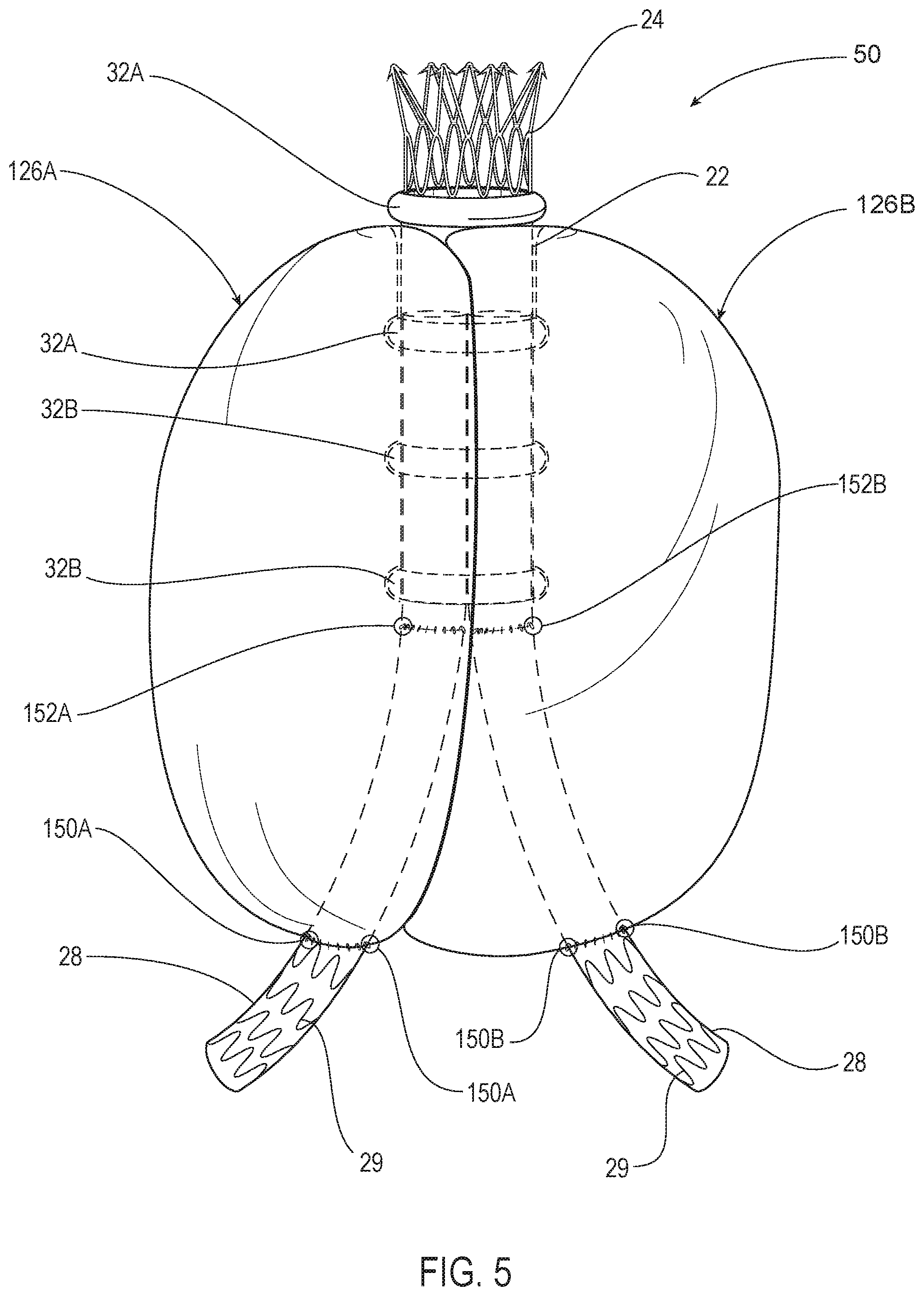 Patent US12350142 Figure 5 – Systems and methods with graft body, inflatable fill channel, and filling structure