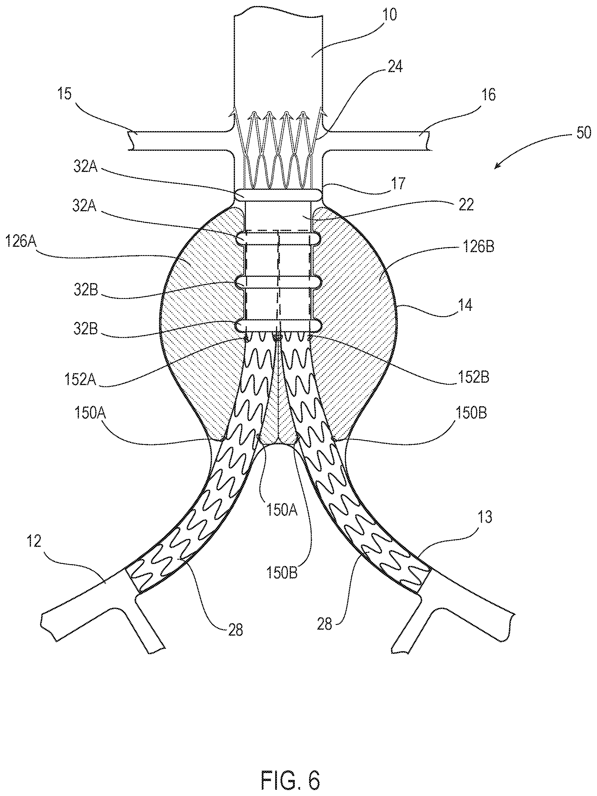Patent US12350142 Figure 6 – Systems and methods with graft body, inflatable fill channel, and filling structure