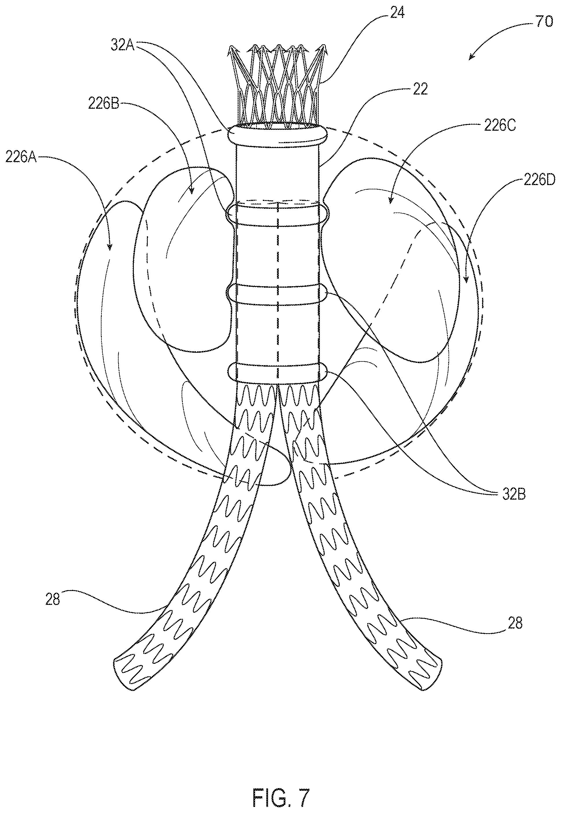 Patent US12350142 Figure 7 – Systems and methods with graft body, inflatable fill channel, and filling structure