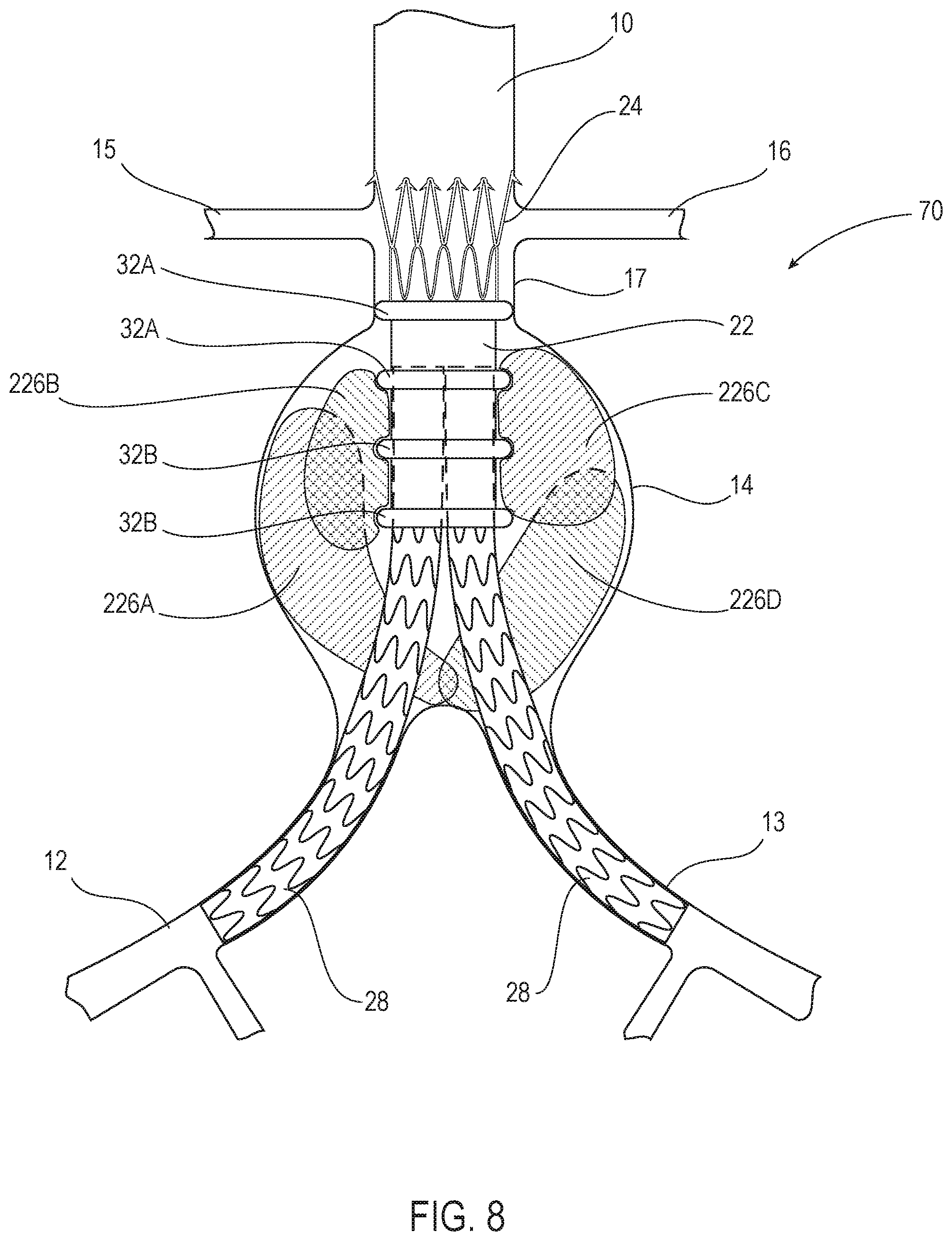 Patent US12350142 Figure 8 – Systems and methods with graft body, inflatable fill channel, and filling structure