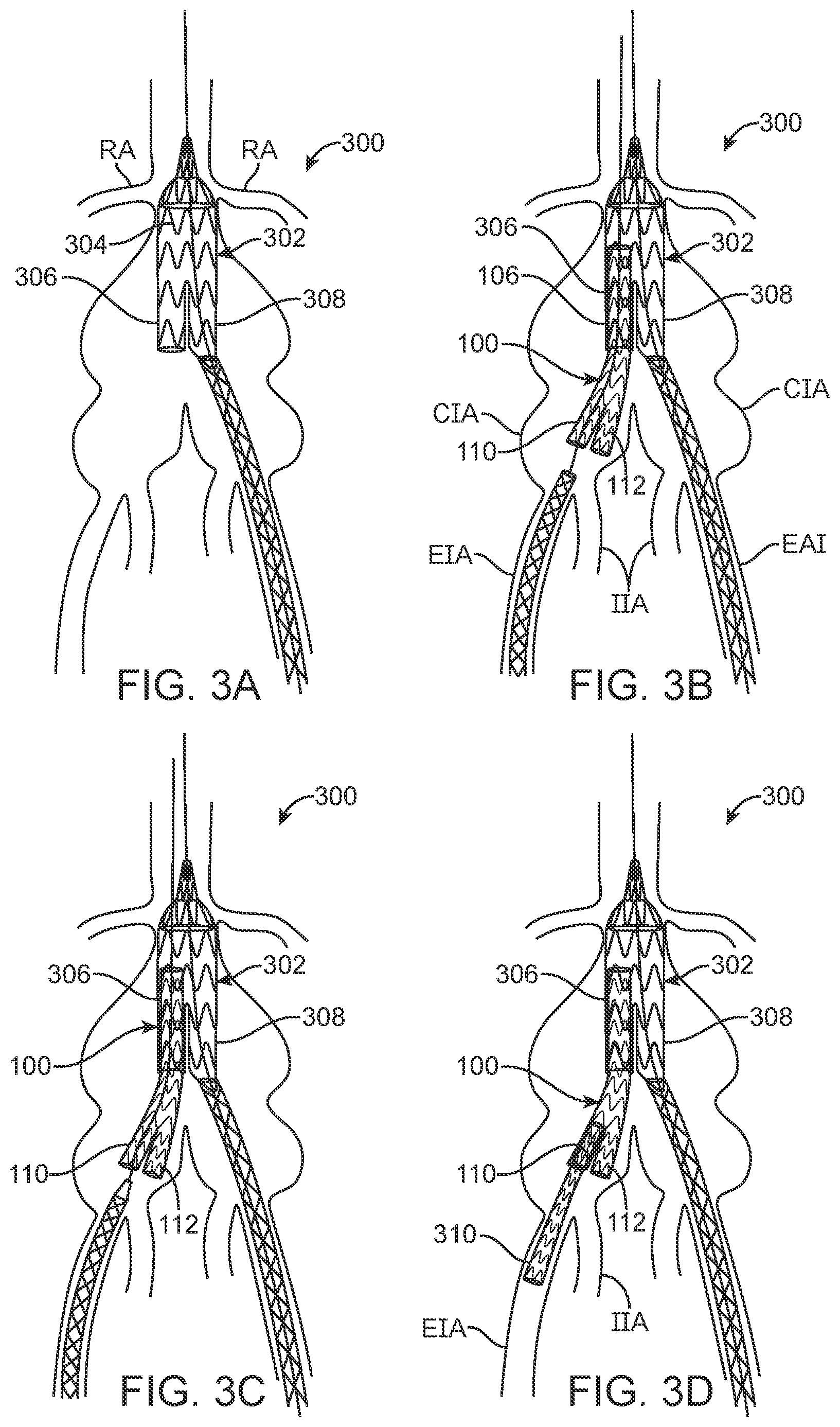 Patent US12350143 Figure 2 – Bifurcating branch modular iliac branch device
