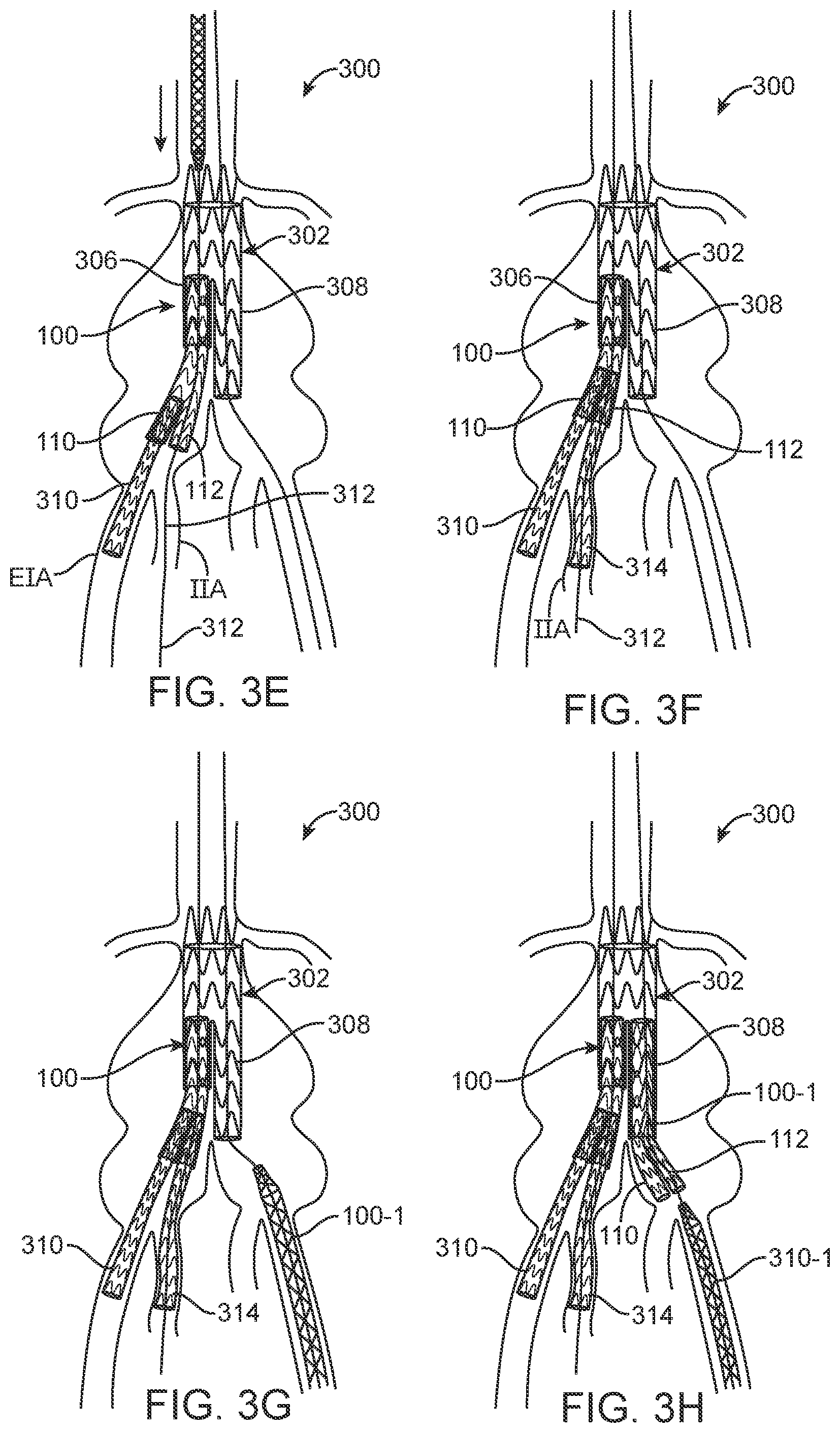Patent US12350143 Figure 3 – Bifurcating branch modular iliac branch device