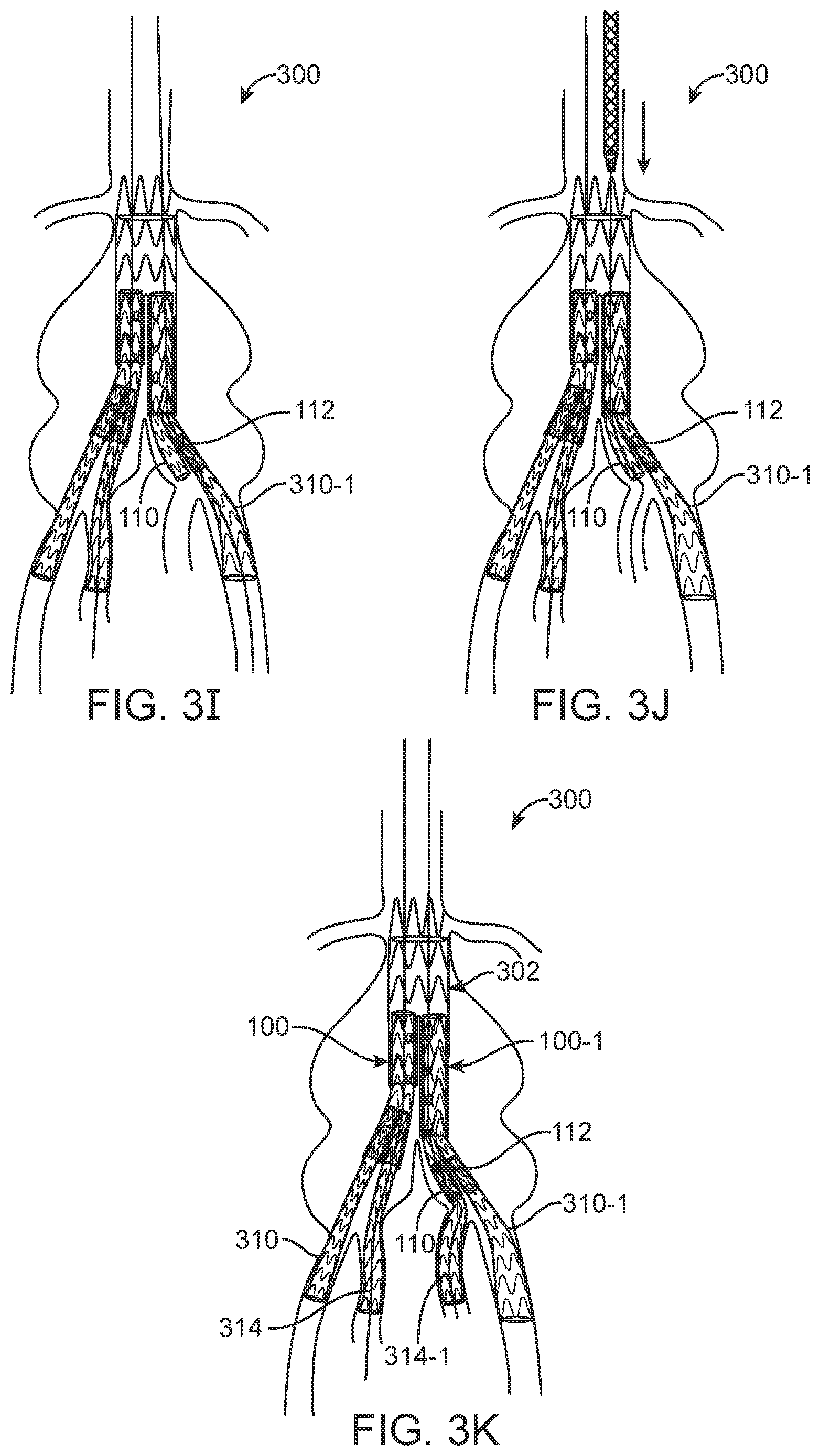 Patent US12350143 Figure 4 – Bifurcating branch modular iliac branch device