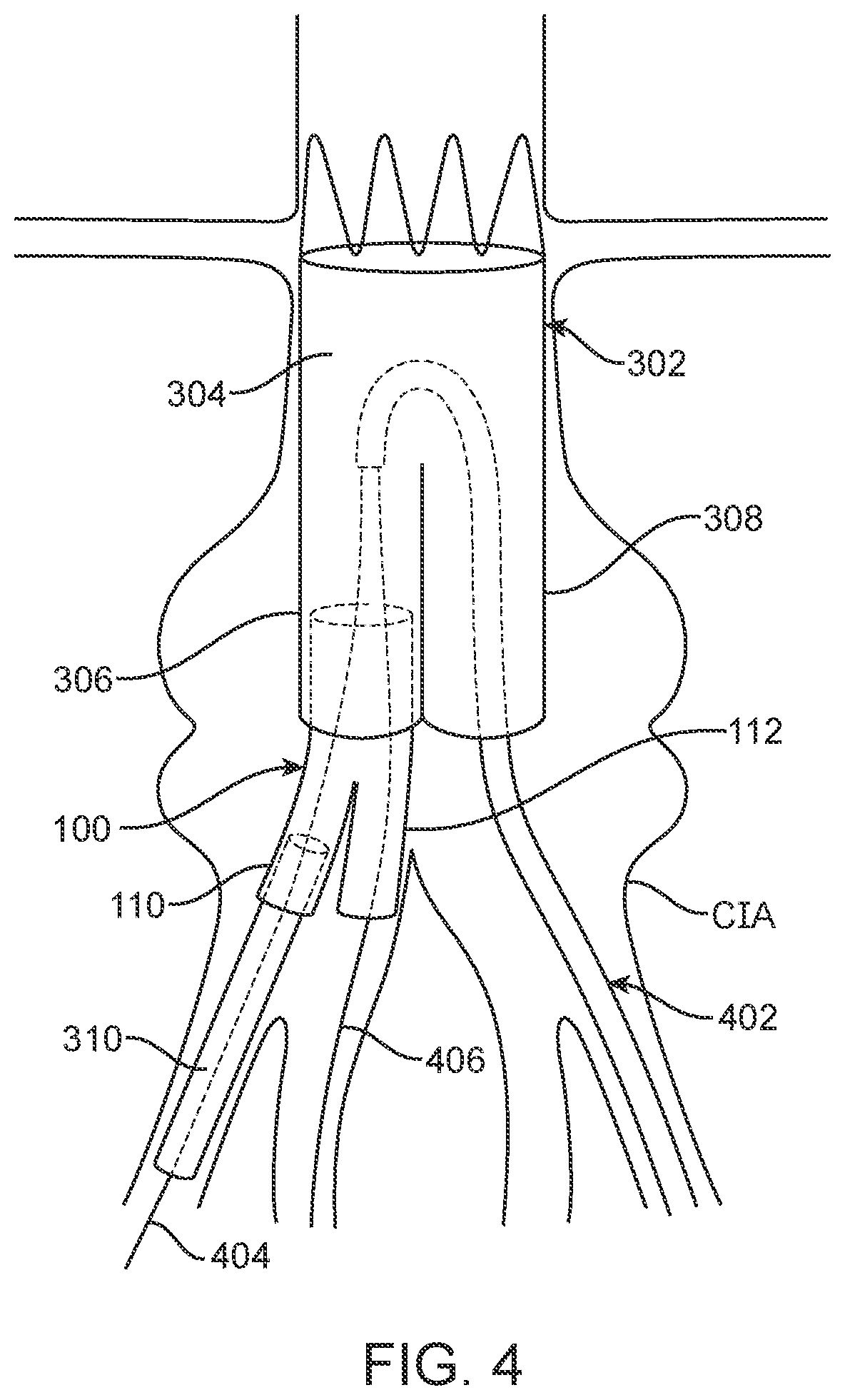 Patent US12350143 Figure 5 – Bifurcating branch modular iliac branch device