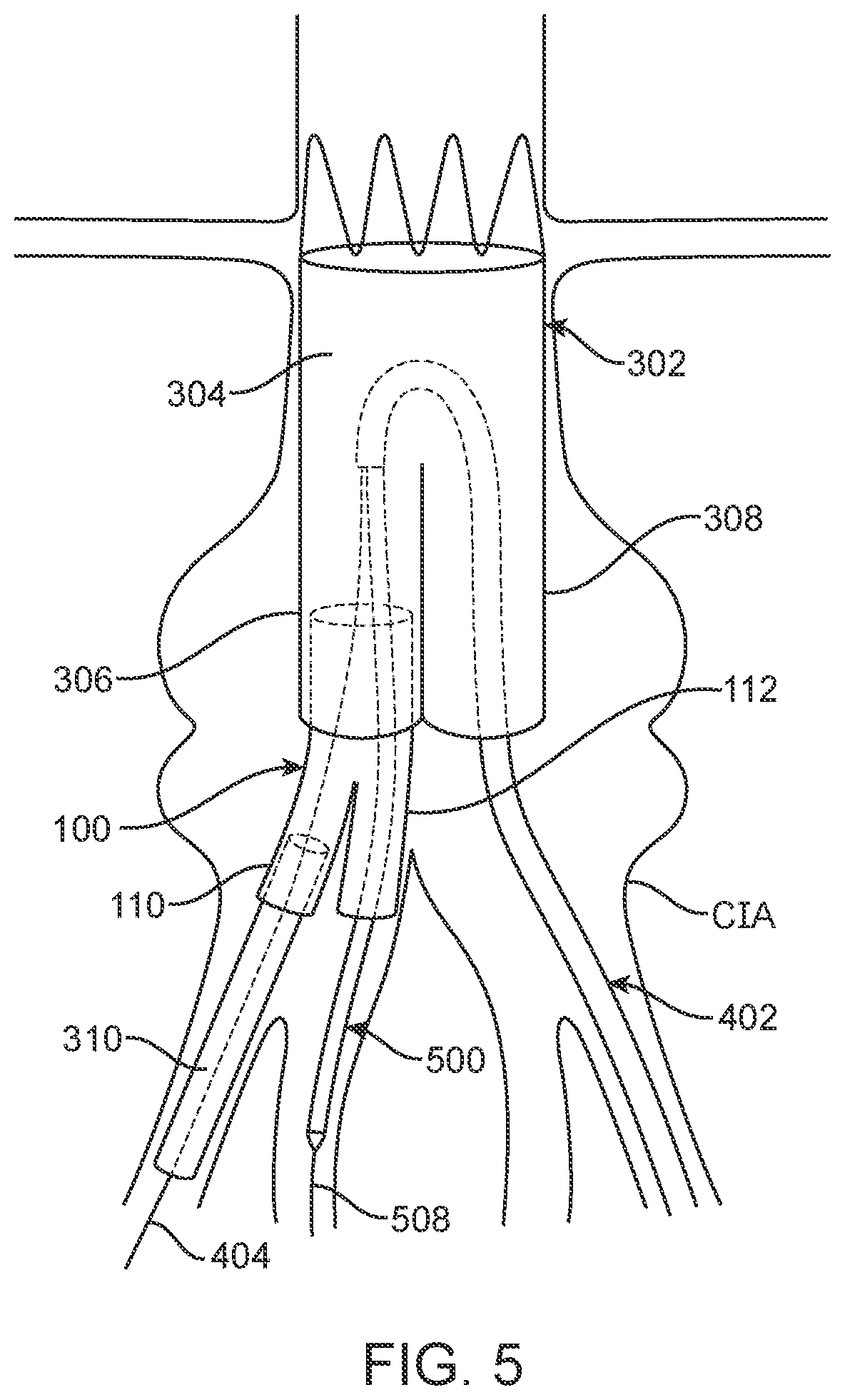 Patent US12350143 Figure 6 – Bifurcating branch modular iliac branch device