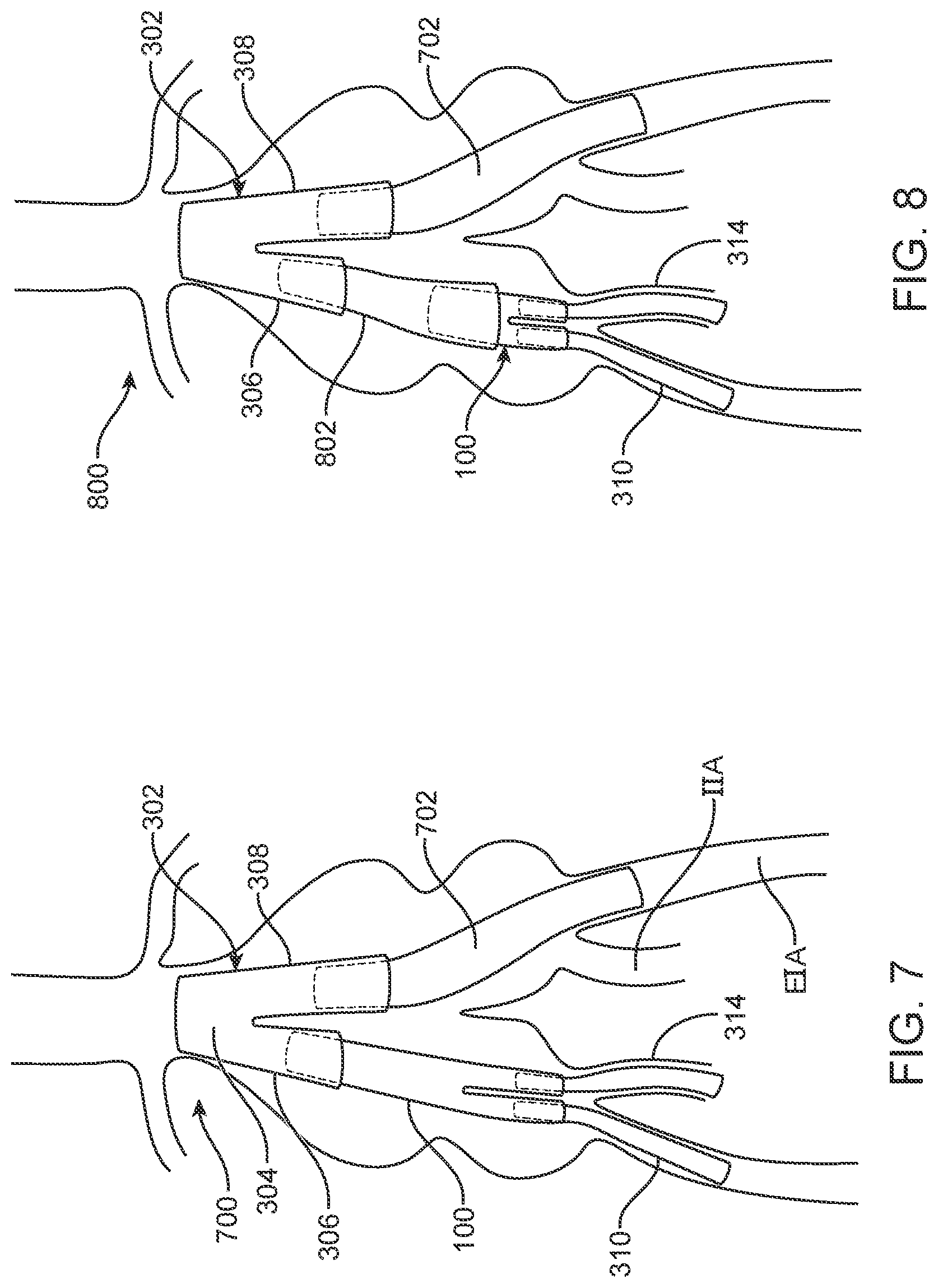 Patent US12350143 Figure 8 – Bifurcating branch modular iliac branch device