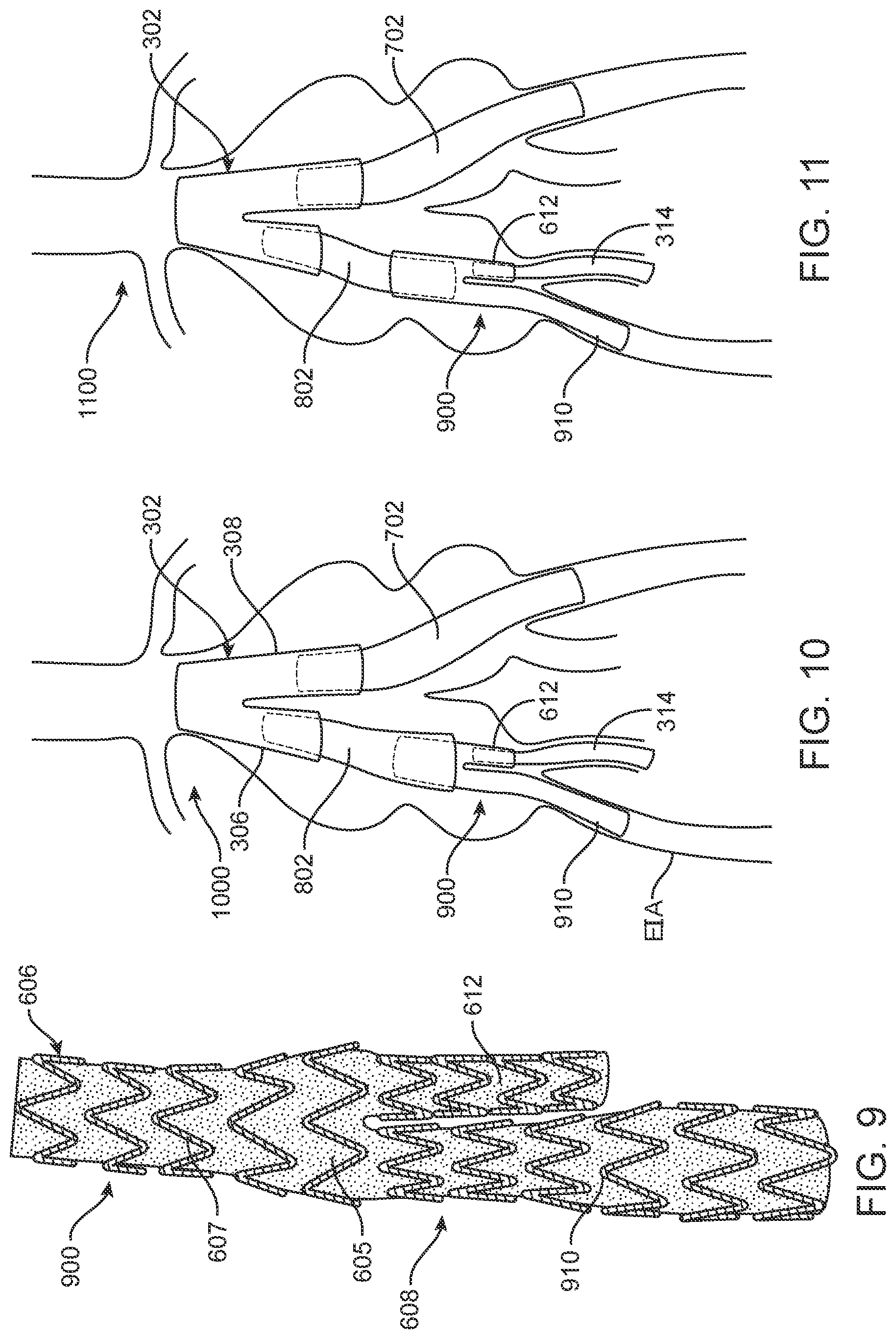 Patent US12350143 Figure 9 – Bifurcating branch modular iliac branch device