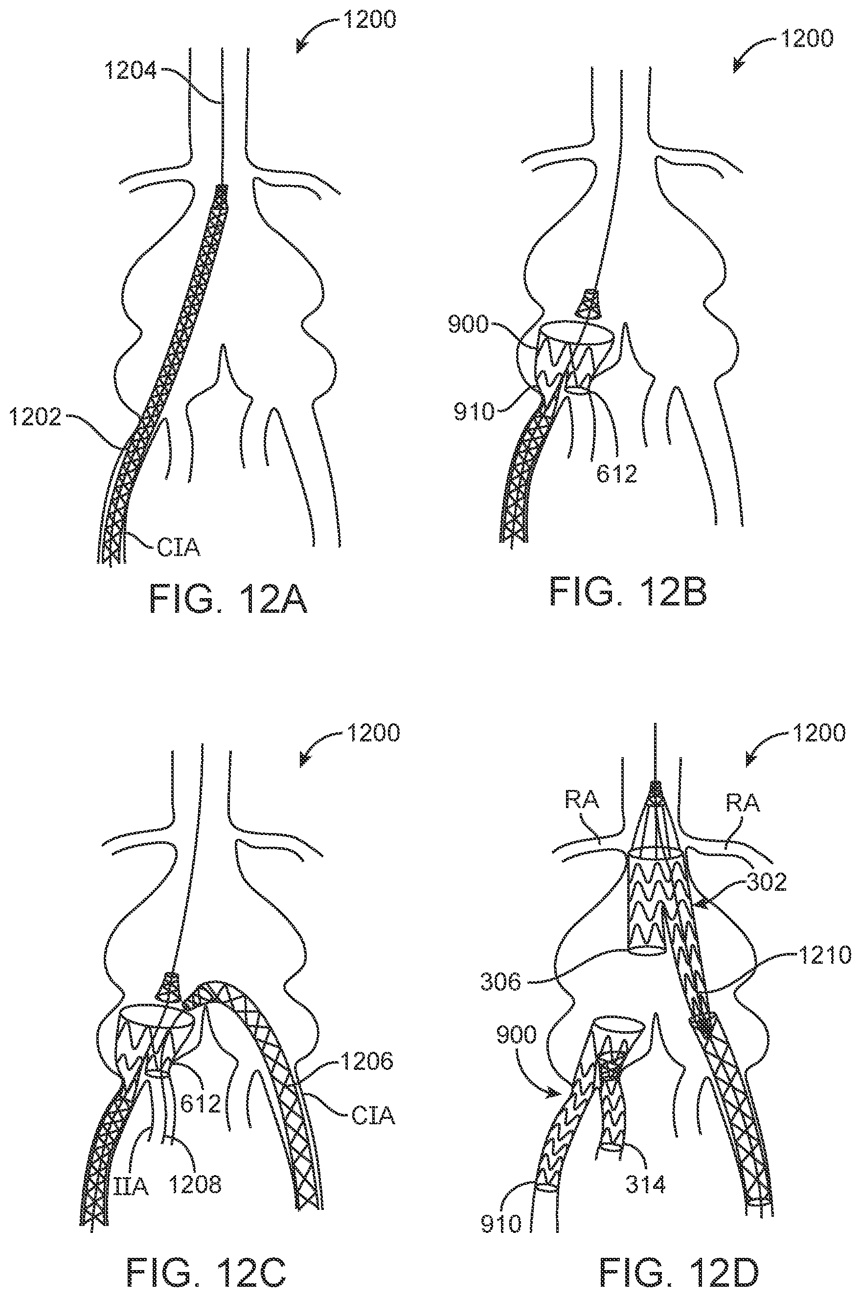 Patent US12350143 Figure 10 – Bifurcating branch modular iliac branch device