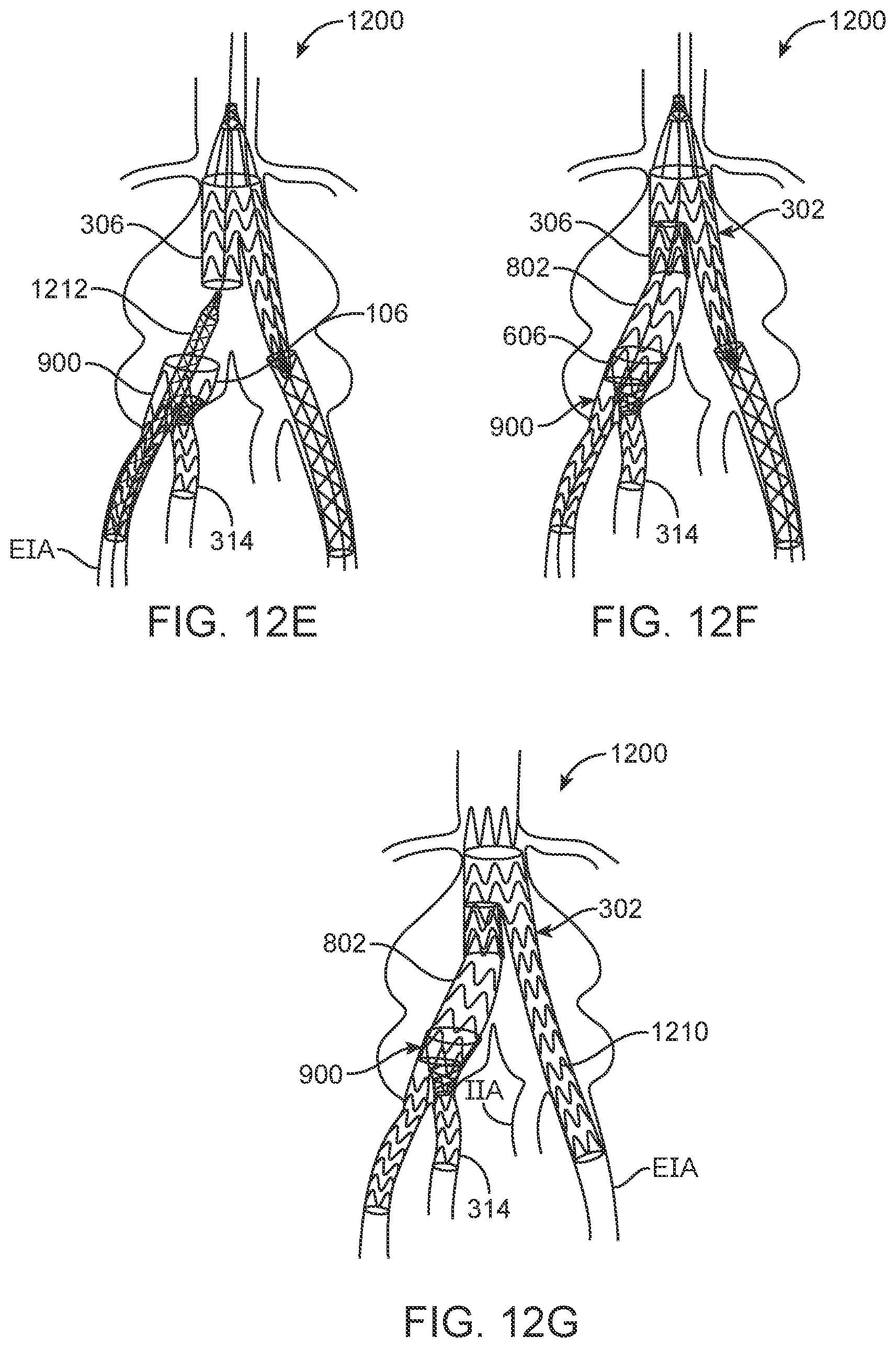 Patent US12350143 Figure 11 – Bifurcating branch modular iliac branch device