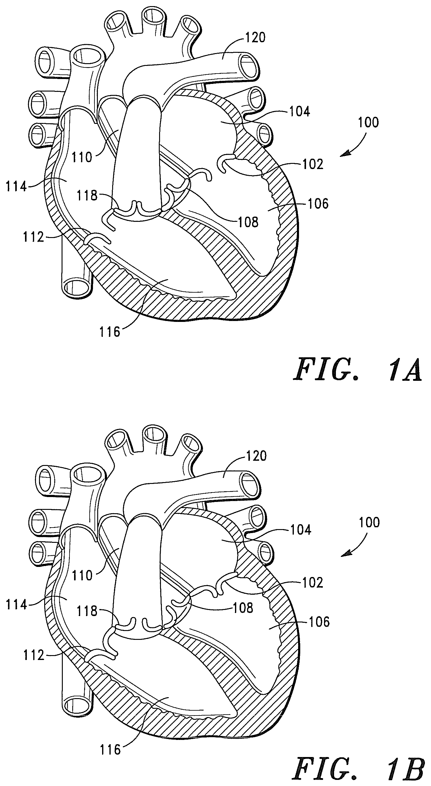 Patent US12350147 Figure 1 – Adaptable prosthetic tissue valves