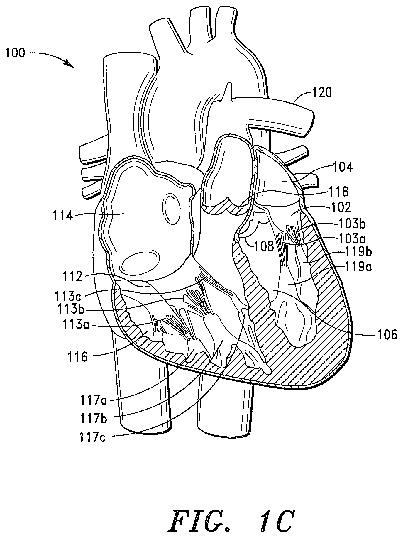 Patent US12350147 Figure 2 – Adaptable prosthetic tissue valves
