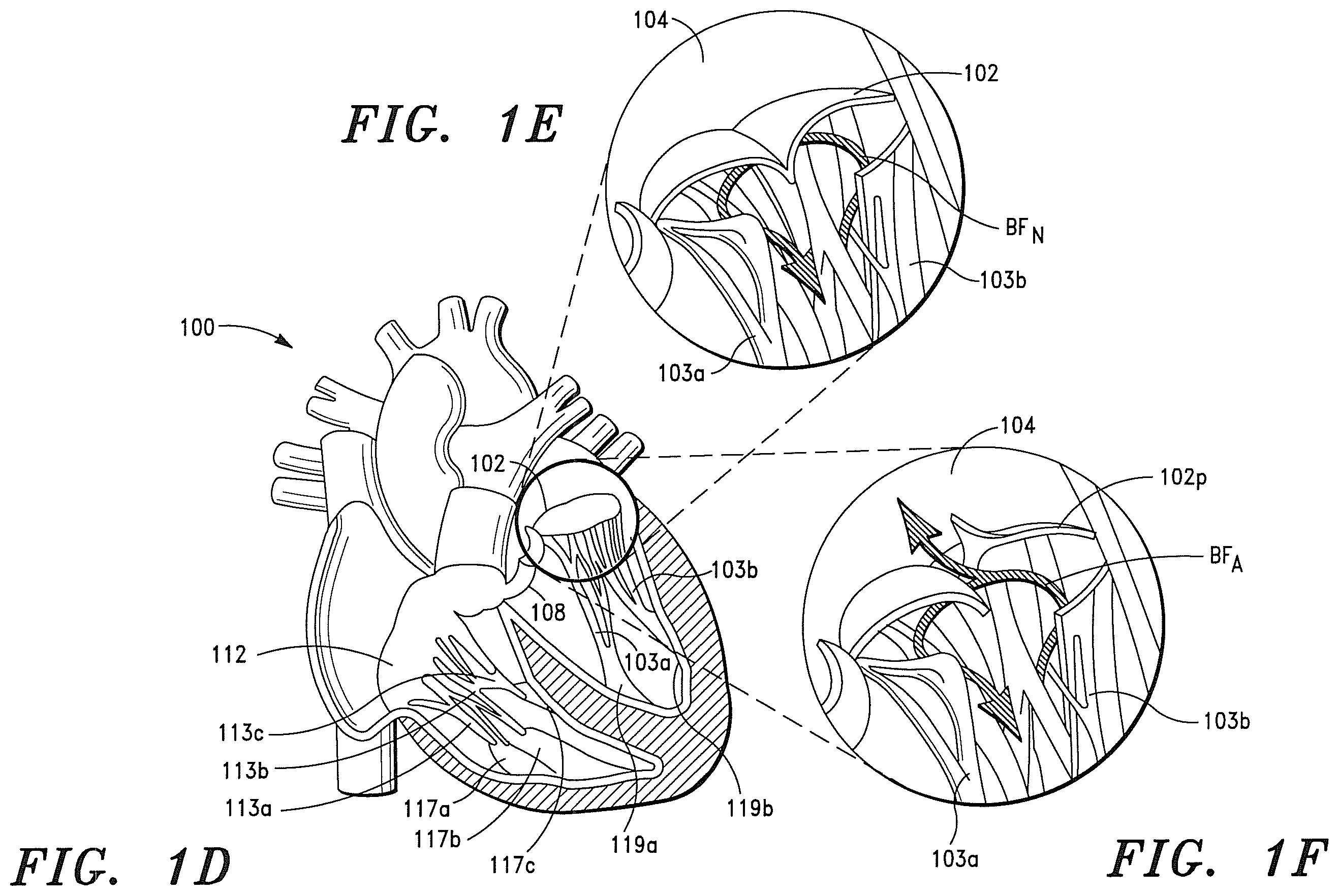 Patent US12350147 Figure 3 – Adaptable prosthetic tissue valves