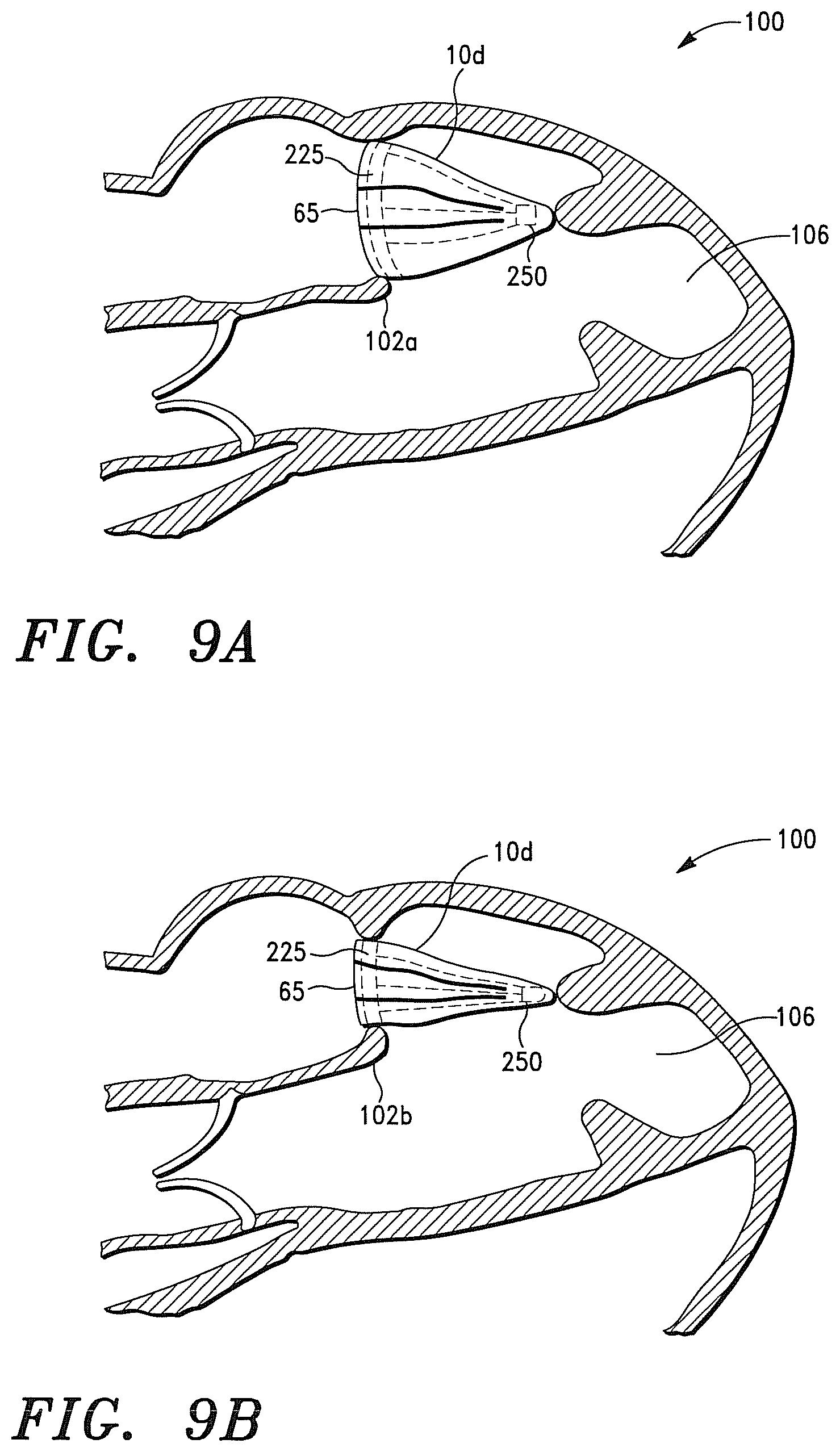 Patent US12350147 Figure 17 – Adaptable prosthetic tissue valves