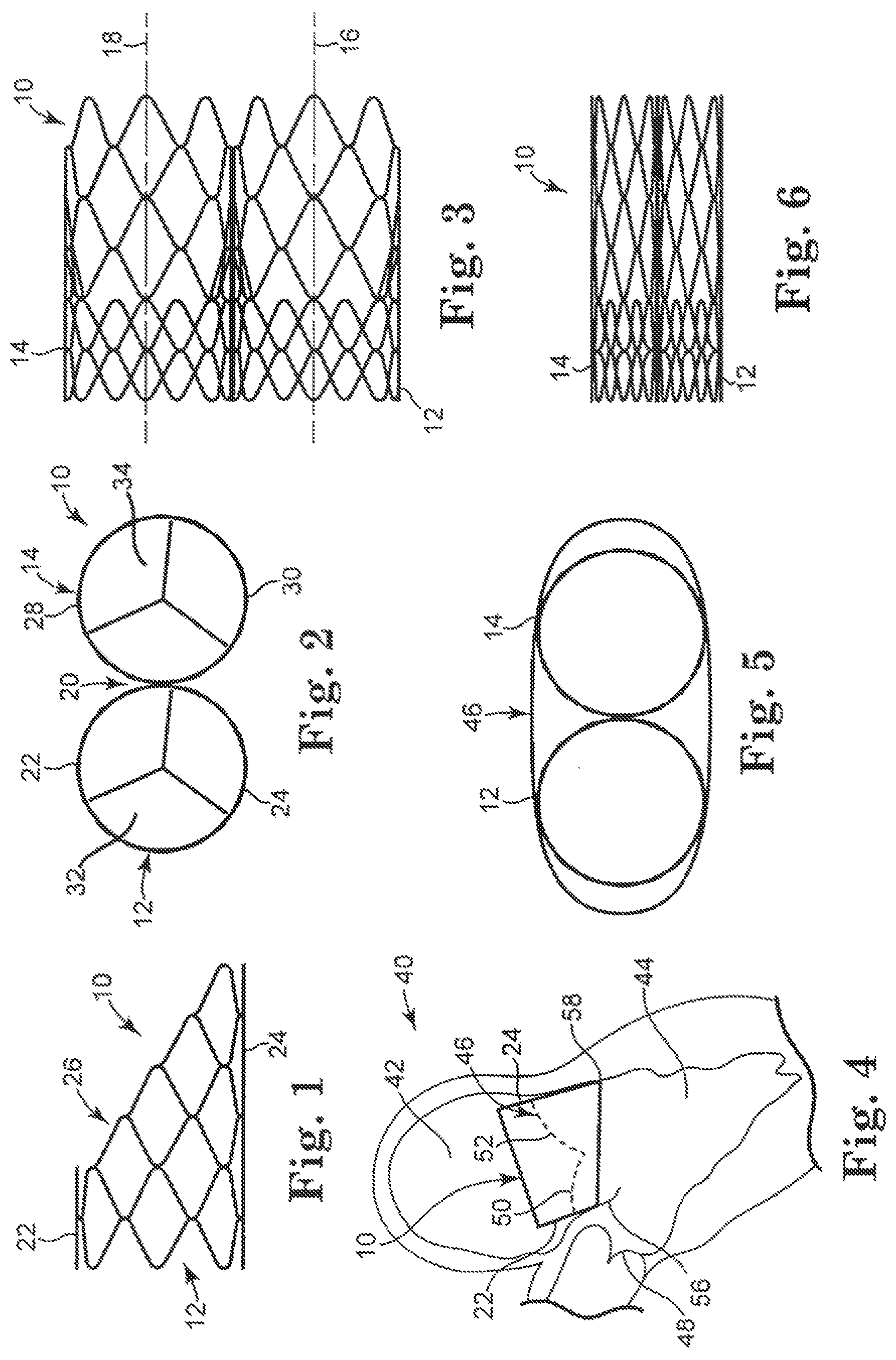 Patent US12350148 Figure 1 – Stented heart valve devices and methods for atrioventricular valve replacement